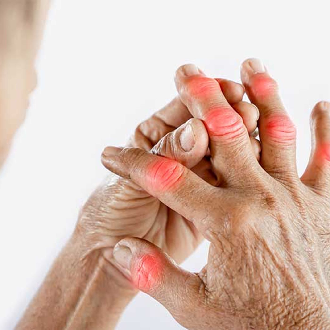 What is Arthritis and Its Symptoms