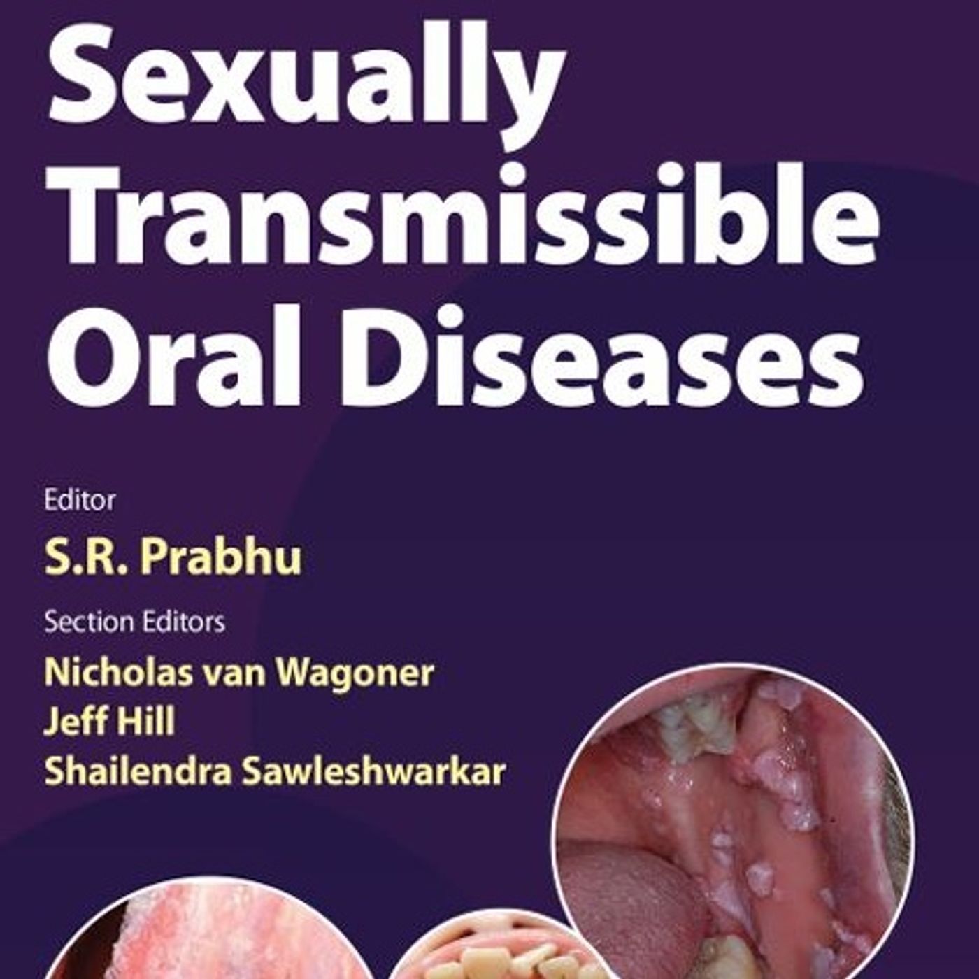 Sexually Transmissible Oral Diseases