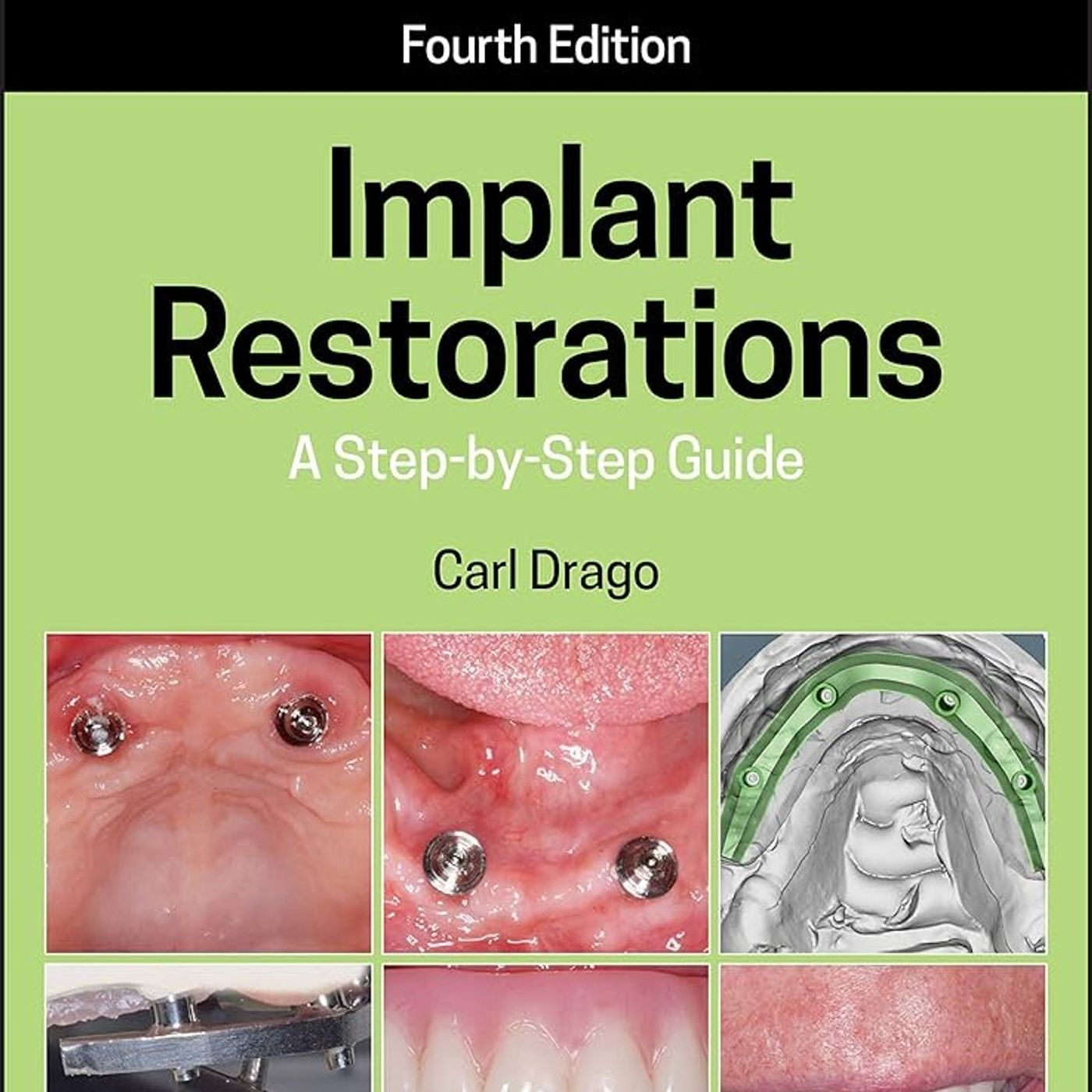 Implant Restorations: A Step-by-Step Guide