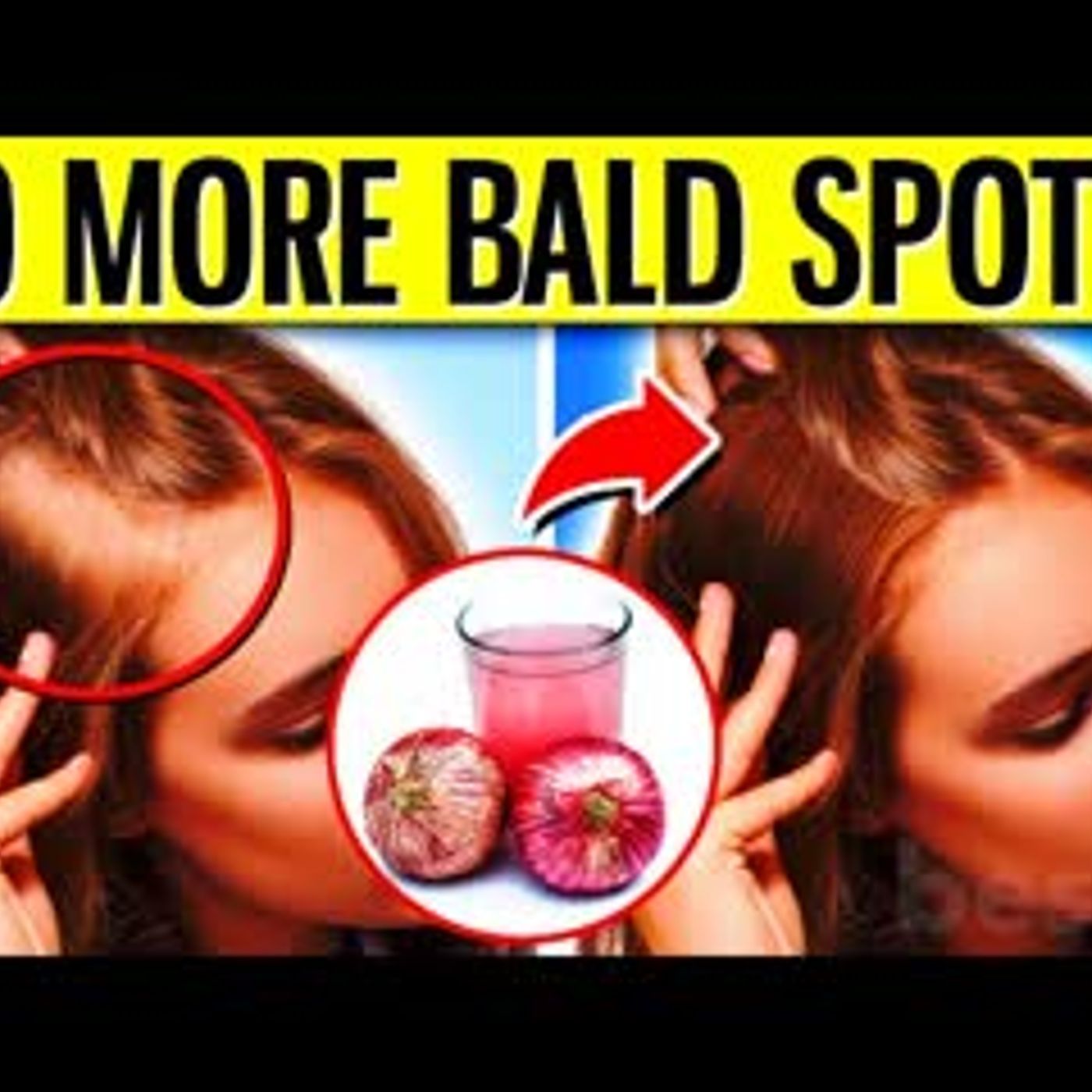 13 Ways To Regrow Your Hair Naturally And Forget About Bald Spots episode artwork