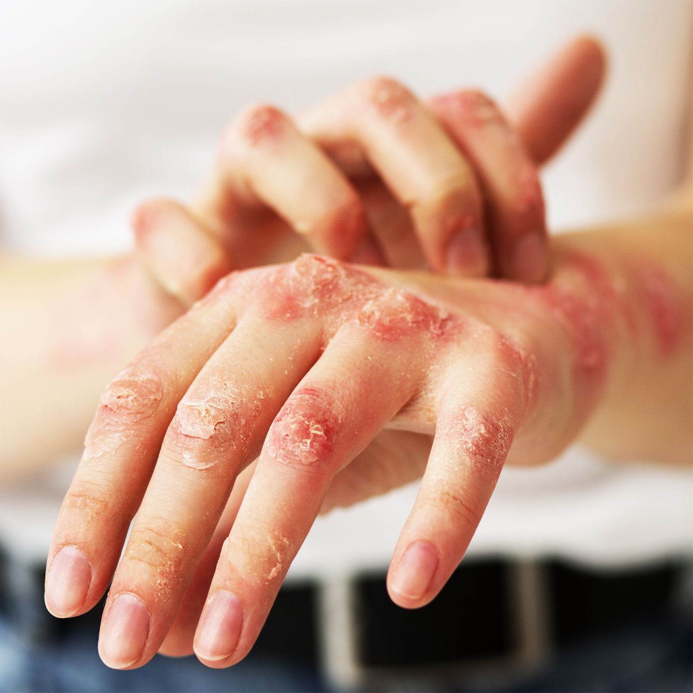 Urticária episode artwork
