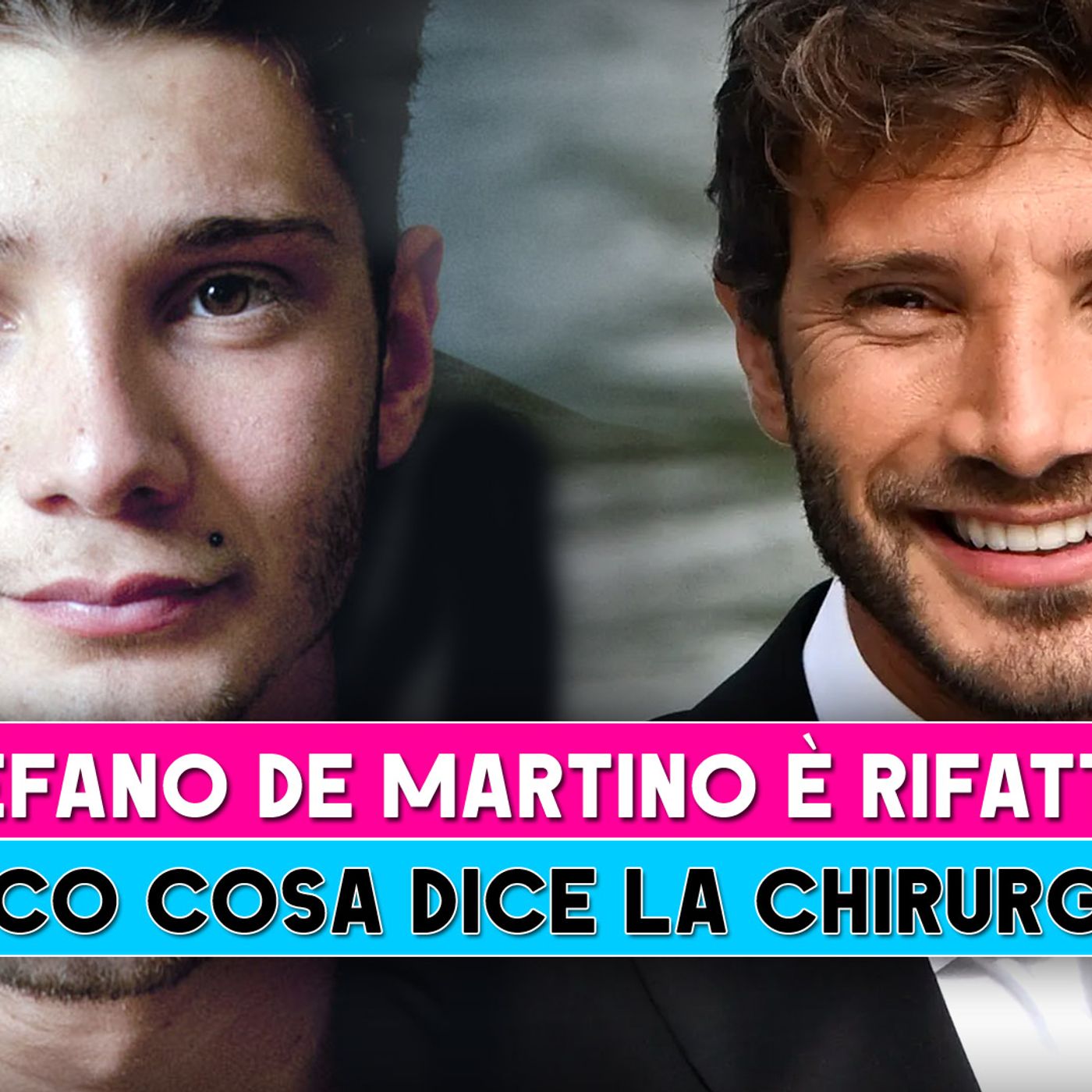 Stefano De Martino E' Rifatto? Ecco Cosa Dice La Chirurga Plastica!