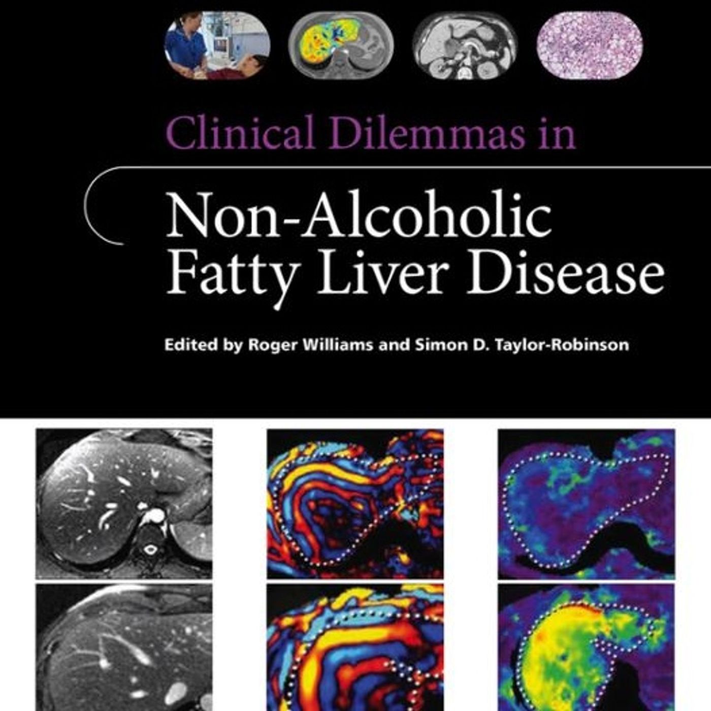 Clinical Dilemmas in Non-Alcoholic Fatty Liver Disease