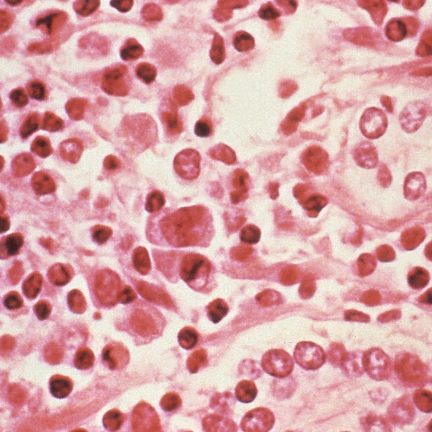 WHO: Hantavirus may have spread between humans — Podcast with everything cover