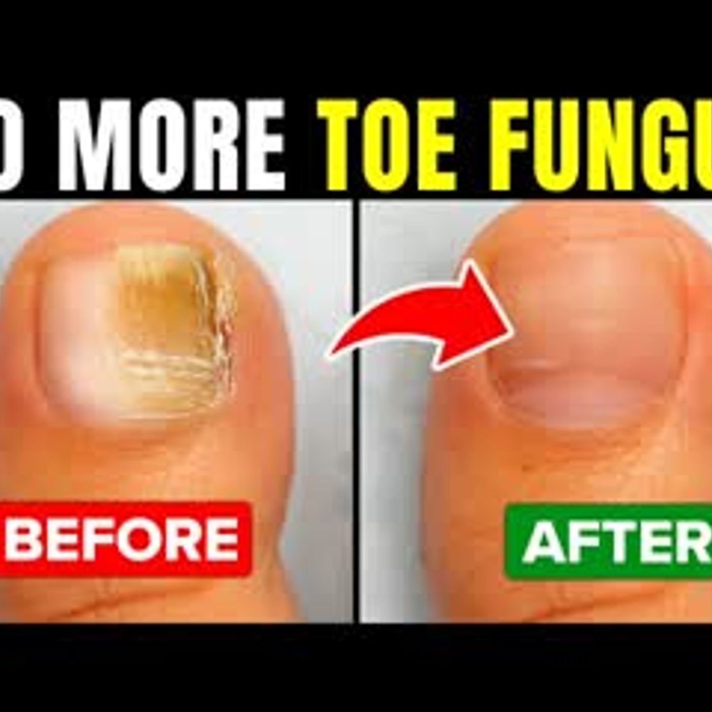 12 Ways To Get Rid of Toenail Fungus Fast and Naturally episode artwork
