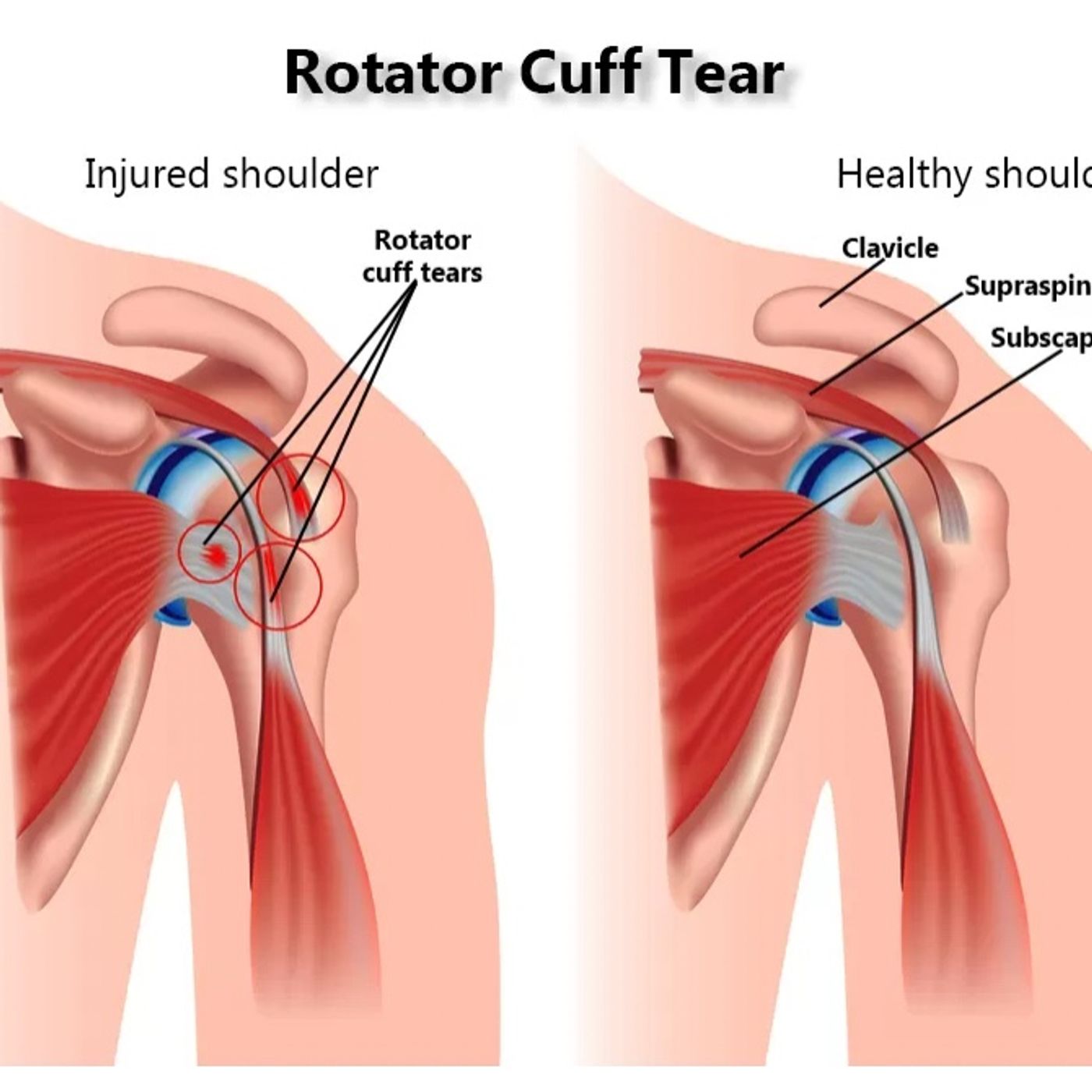 Rotator Cuff Injury