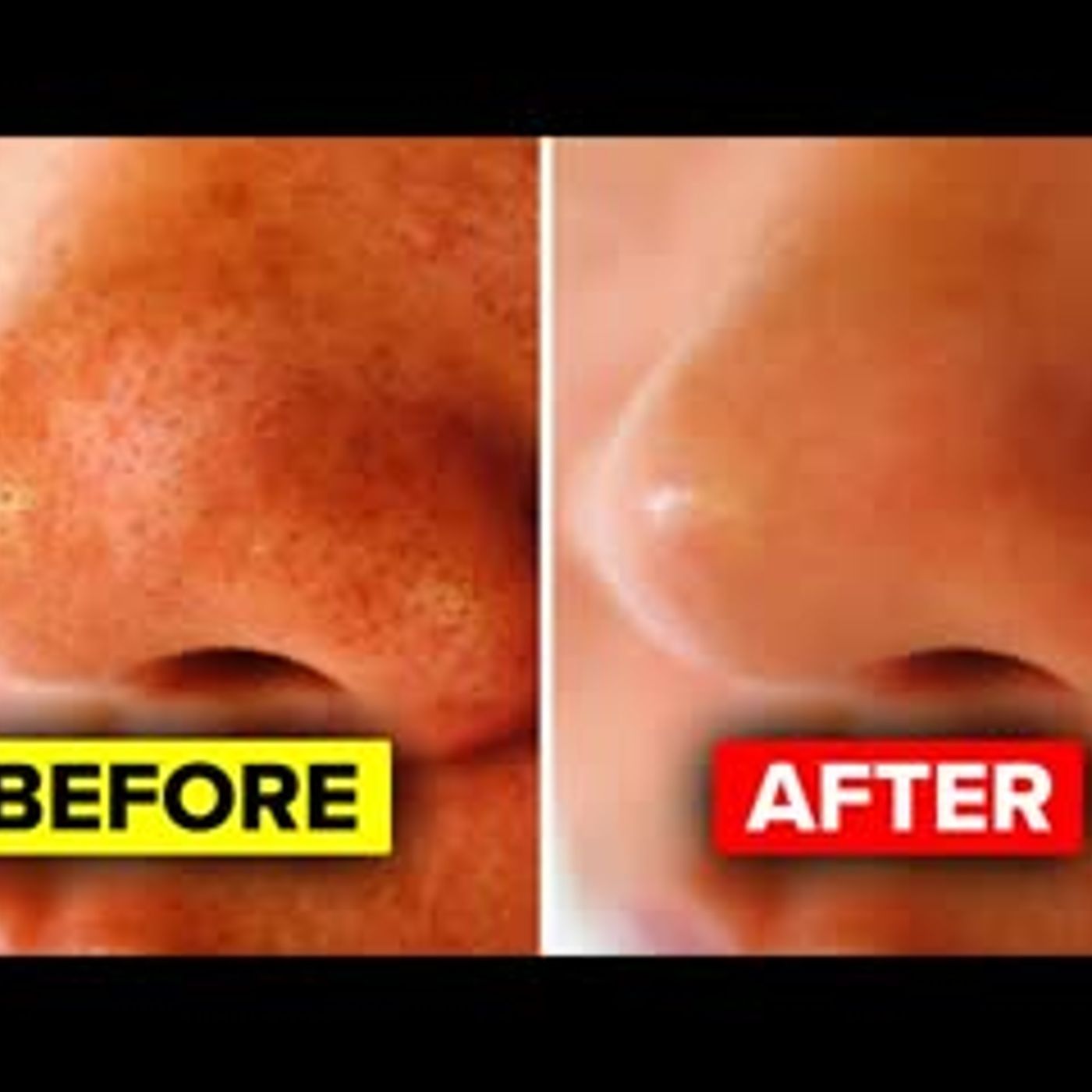 11 Ways To Tighten Large Pores Suggested By Dermatologists episode artwork