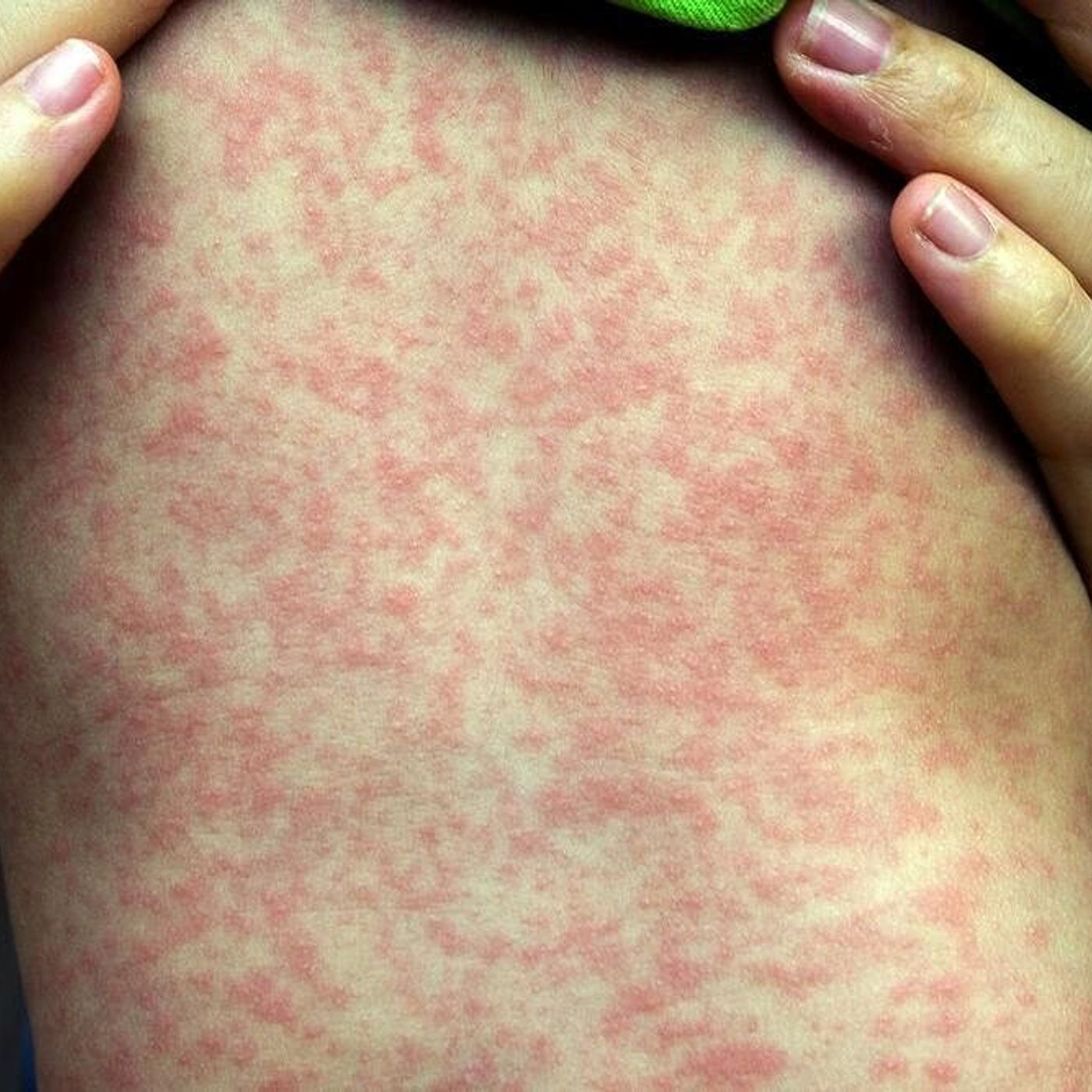 Measles case confirmed in Kane County; Health Department investigating potential exposures episode artwork