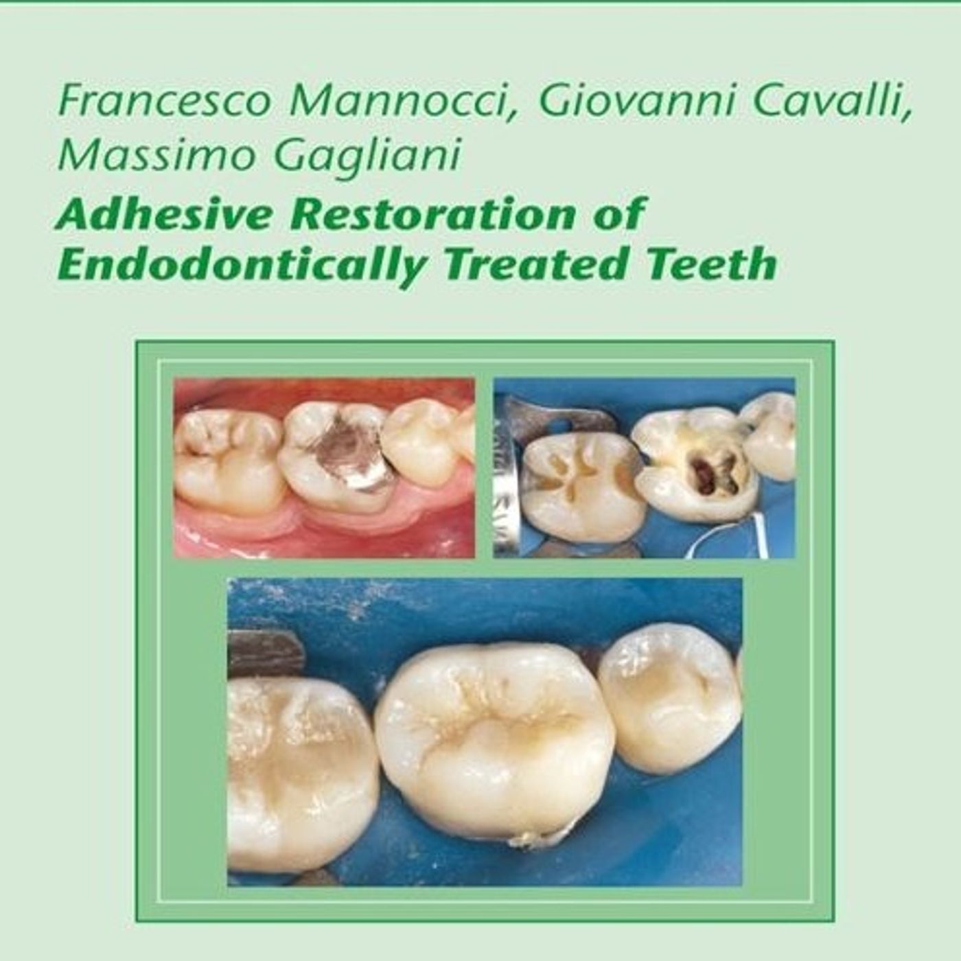AdhesiveRestoration of Endodontically TreatedTeeth
