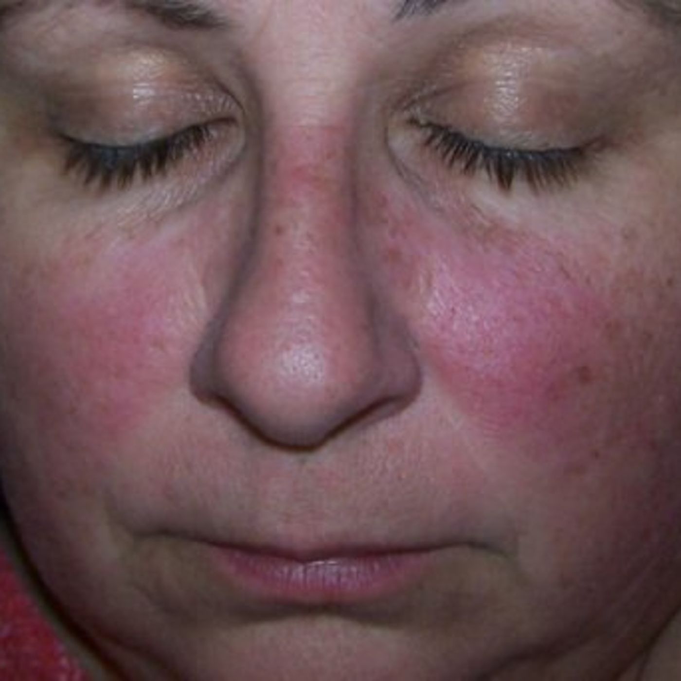 Susan Hendrix My Story Living With Lupus