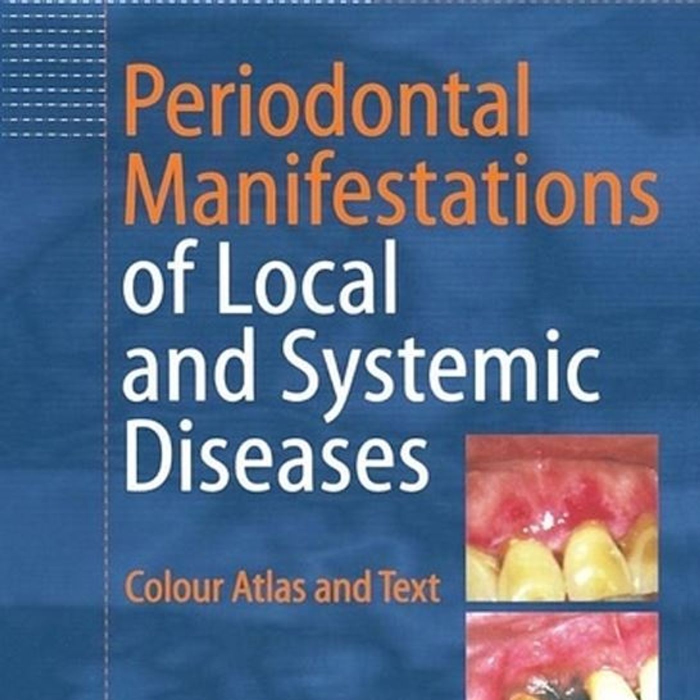 Periodontal Manifestations of Local and Systemic Diseases