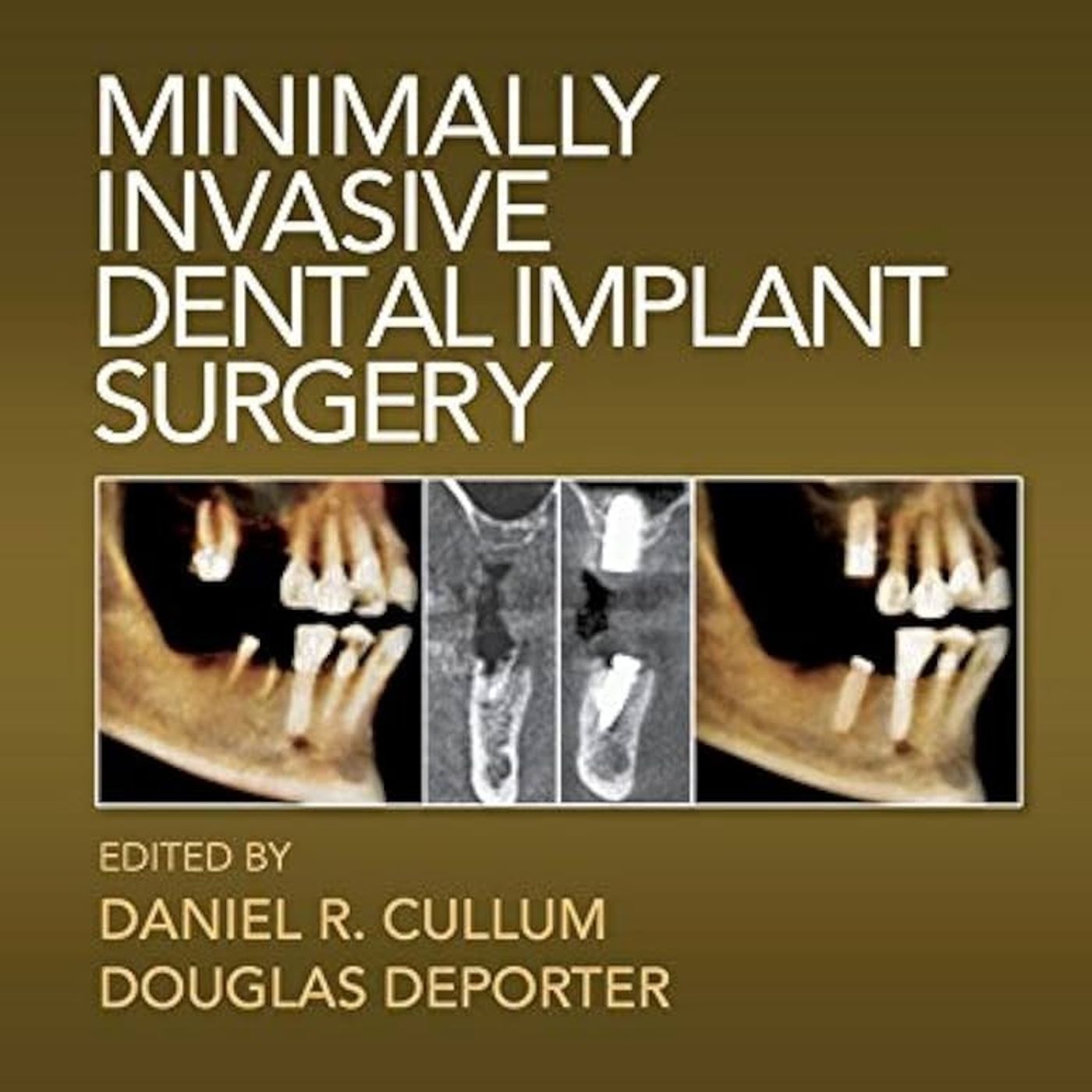 Minimally Invasive Dental Implant Surgery