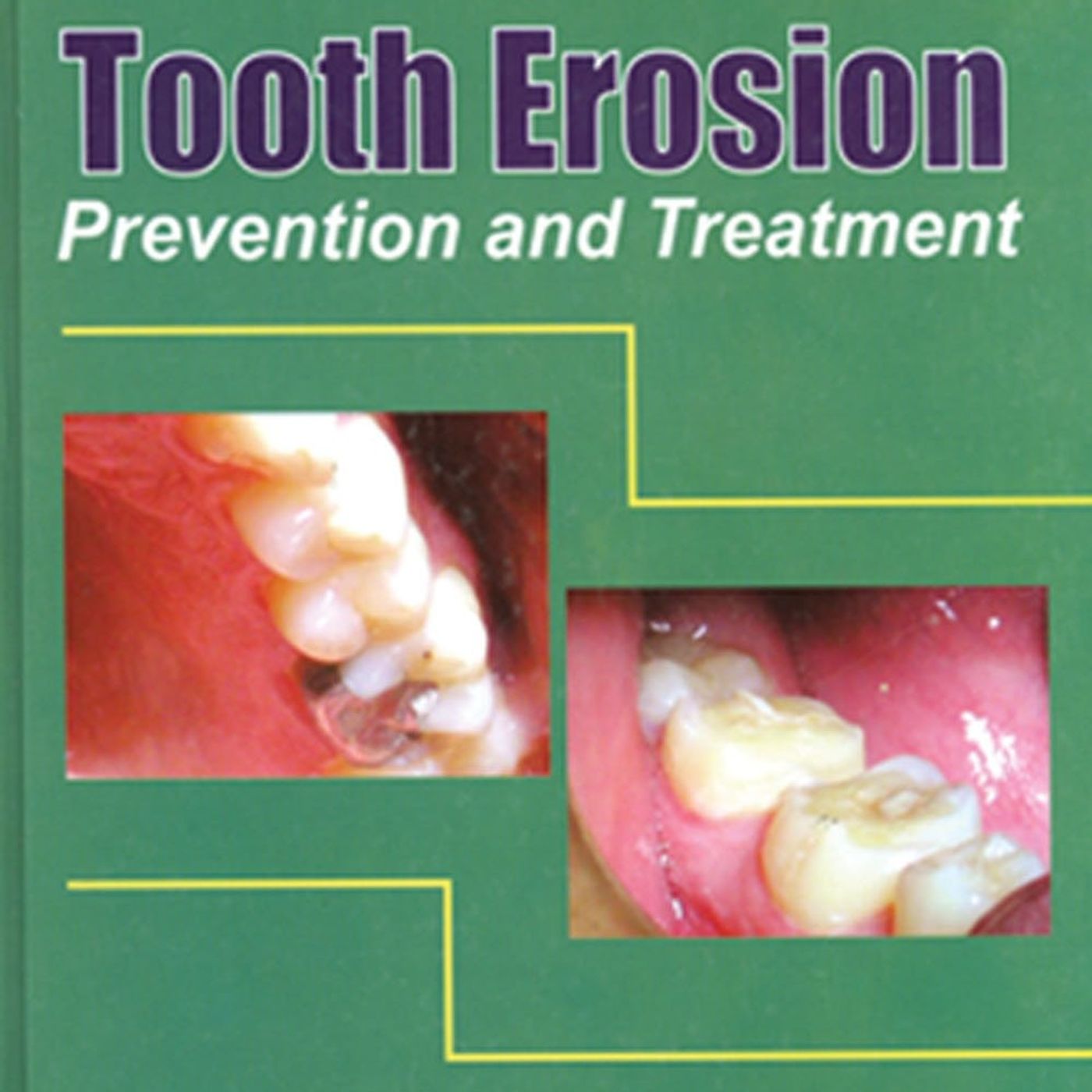 Tooth Erosion: Prevention and Treatment