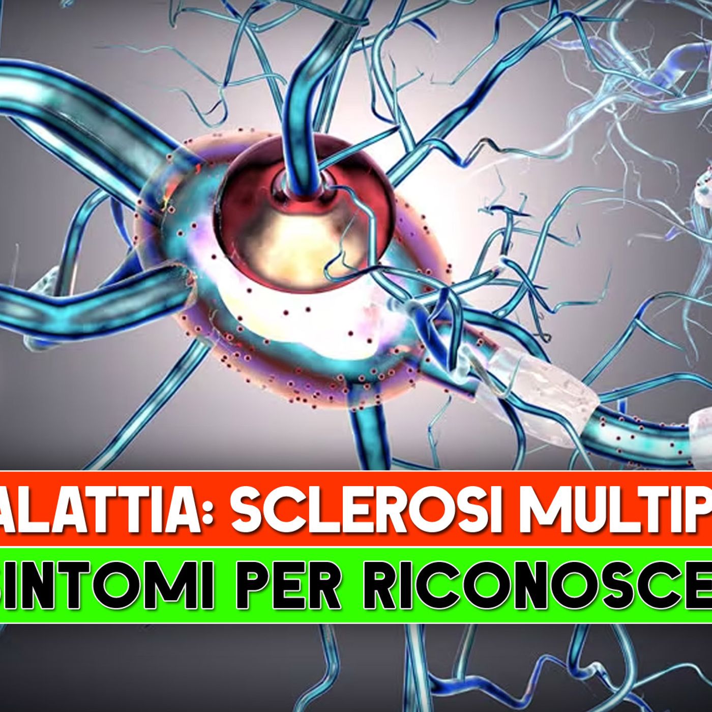 Malattia Autoimmune, Sclerosi Multipla: I 5 Sintomi Per Riconoscerla! episode artwork