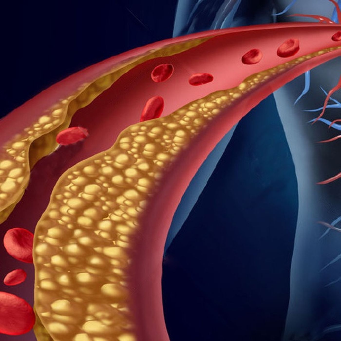 Dislipidemia tratamiento y recomendaciones episode artwork