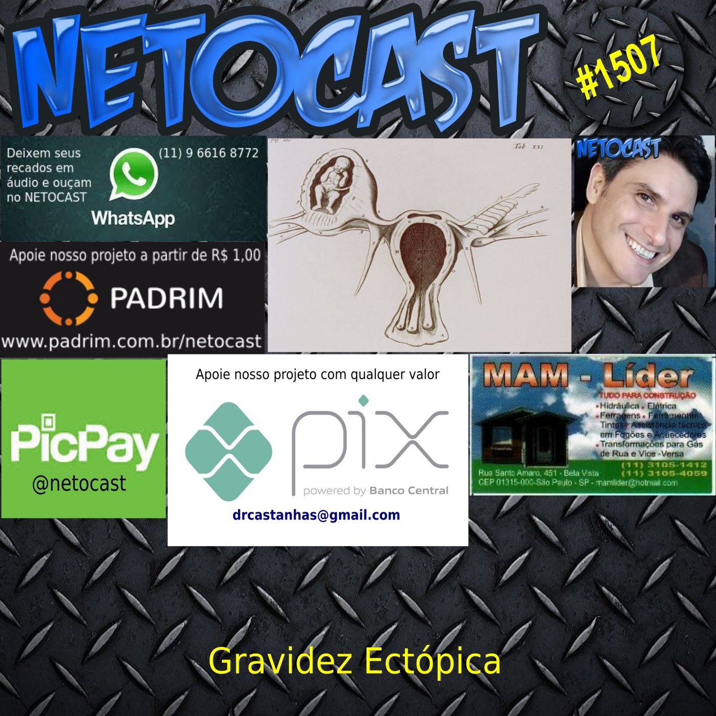 NETOCAST 1507 de 10/07/2022 - Gravidez ectópica