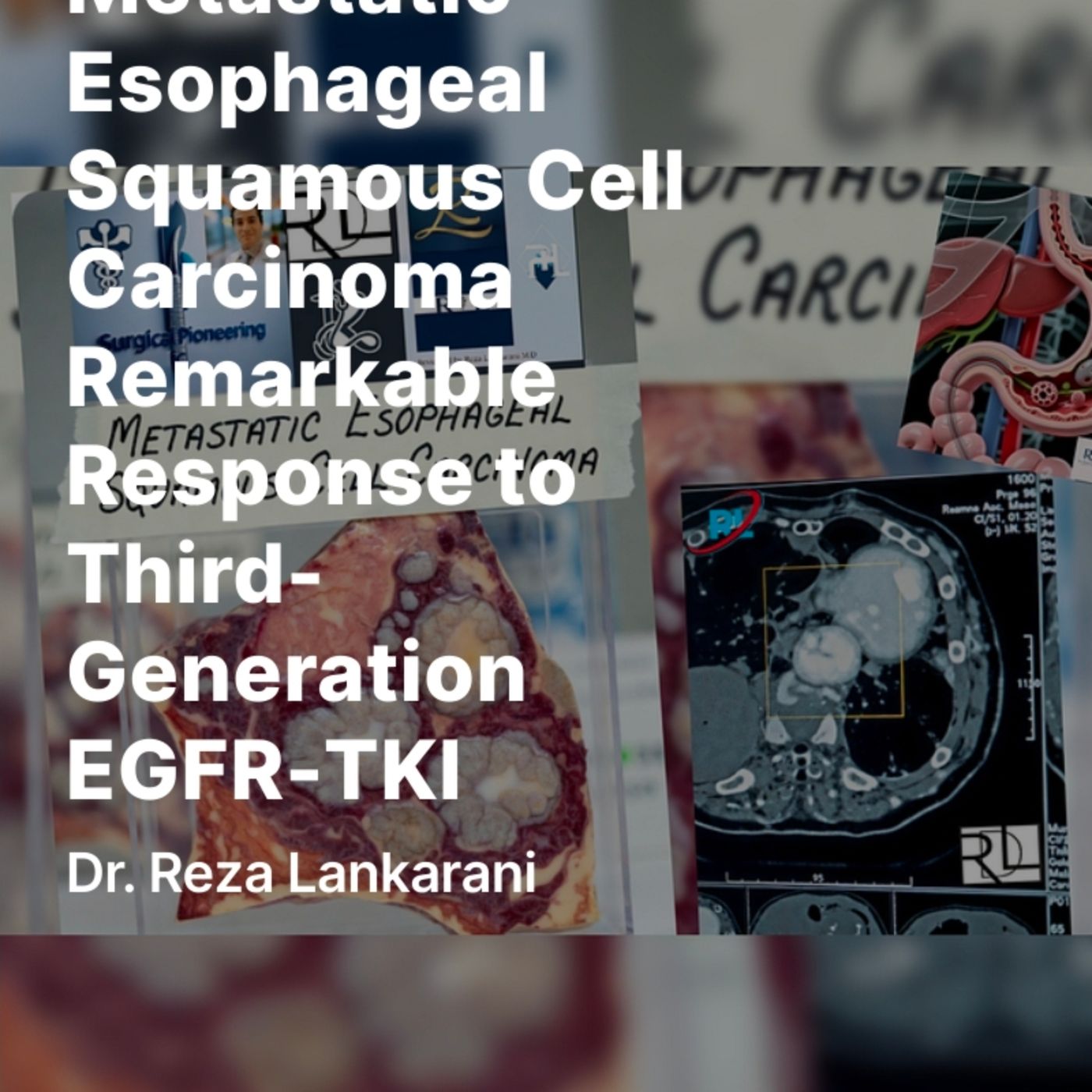 Metastatic Esophageal Squamous Cell Carcinoma Remarkable Response to Third-Generation EGFR TKI episode artwork