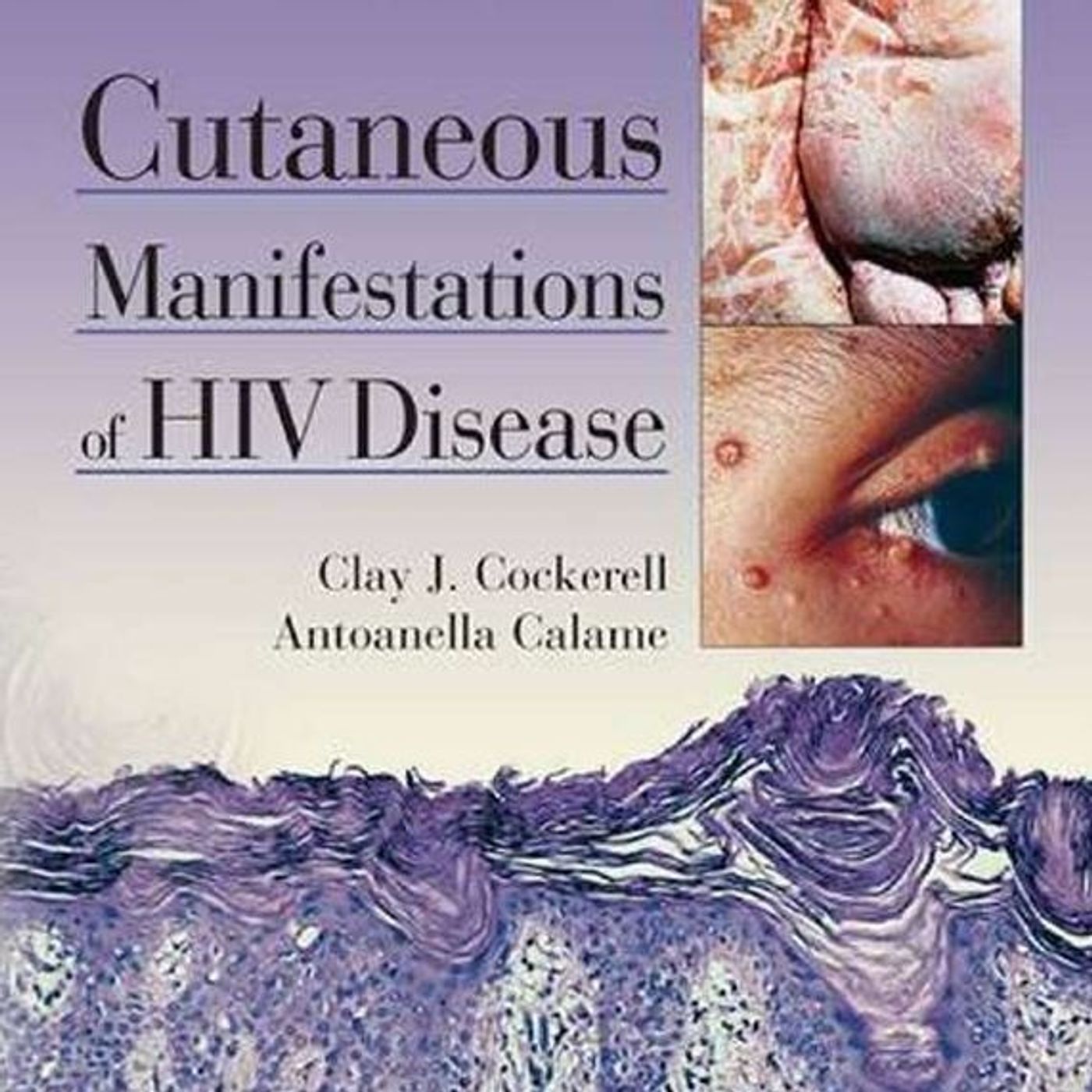 Cutaneous Manifestations Of Hiv Disease