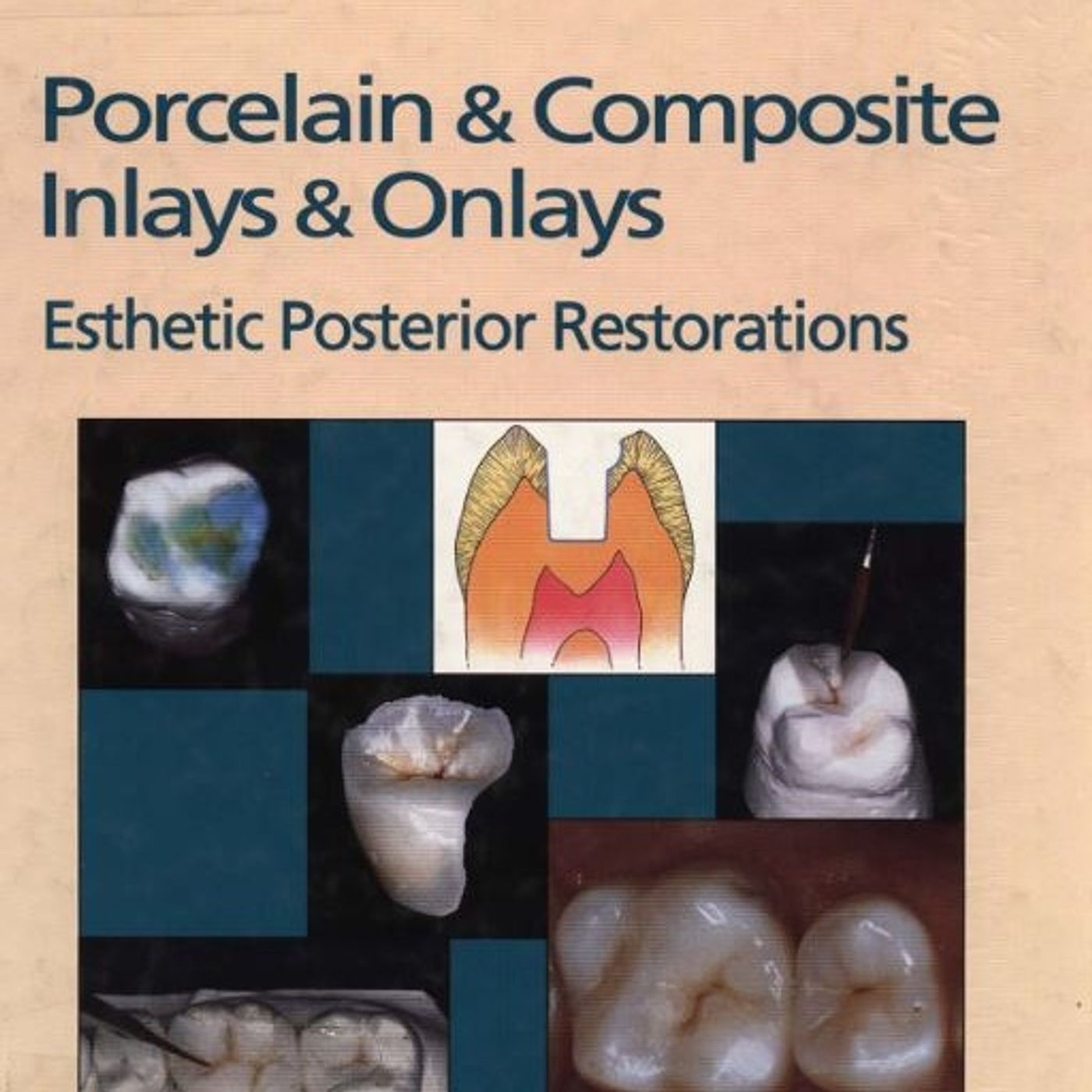 Porcelain & Composite Inlays & Onlays: Esthetic Posterior Restorations