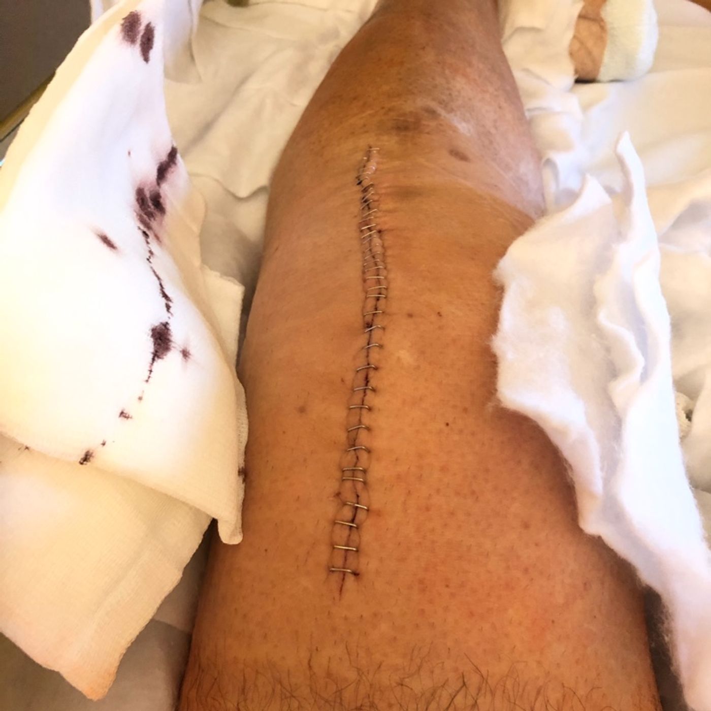 Odisea hospitalaria !! Prótesis de rodilla 3 intervención. episode artwork