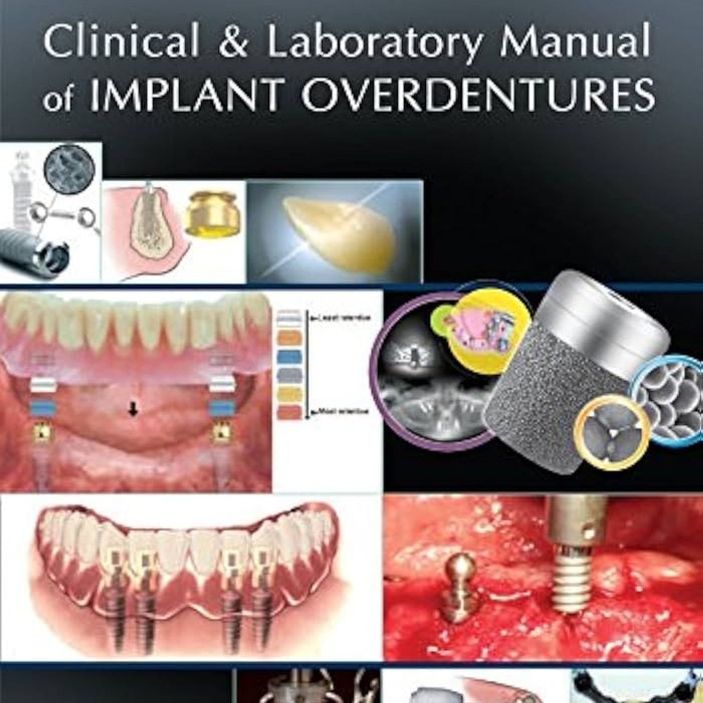 Clinical and Laboratory Manual of Implant Overdentures