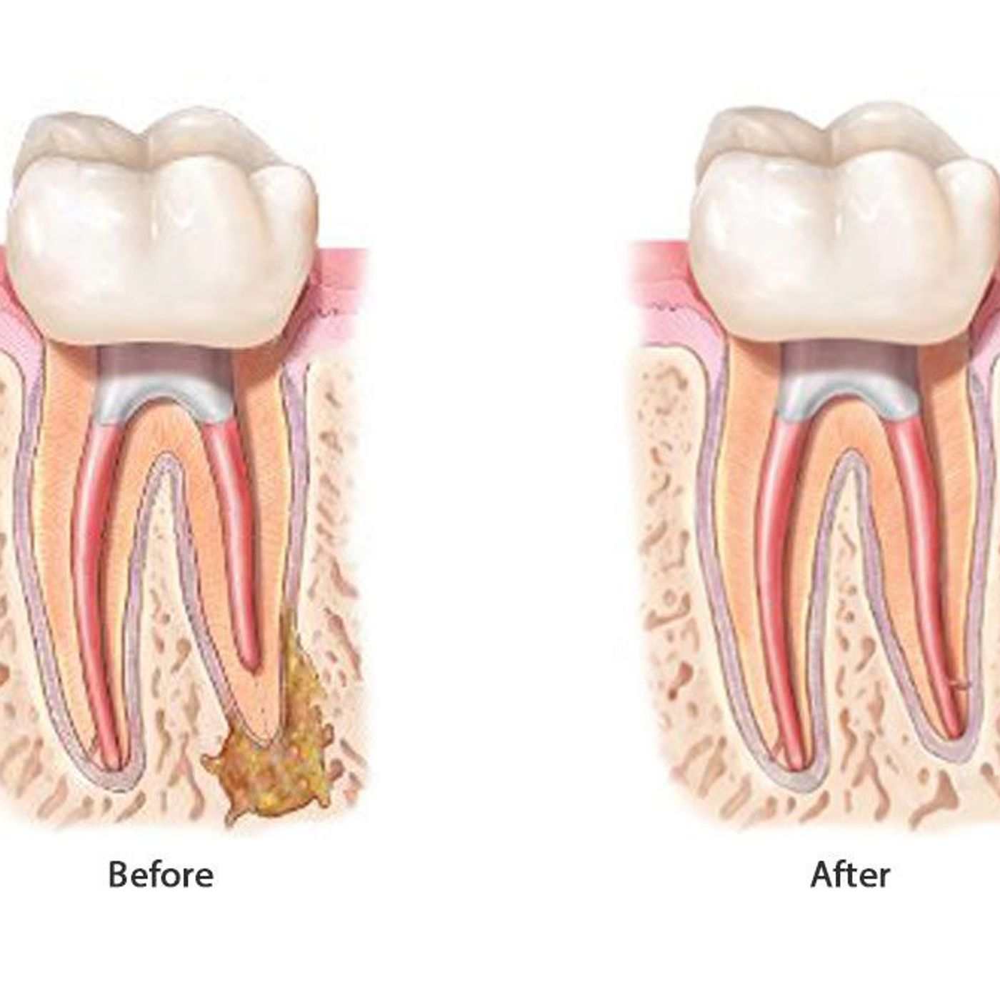 What Is Endodontics and How Can It Save Your Tooth in Hampton Township, NJ episode artwork