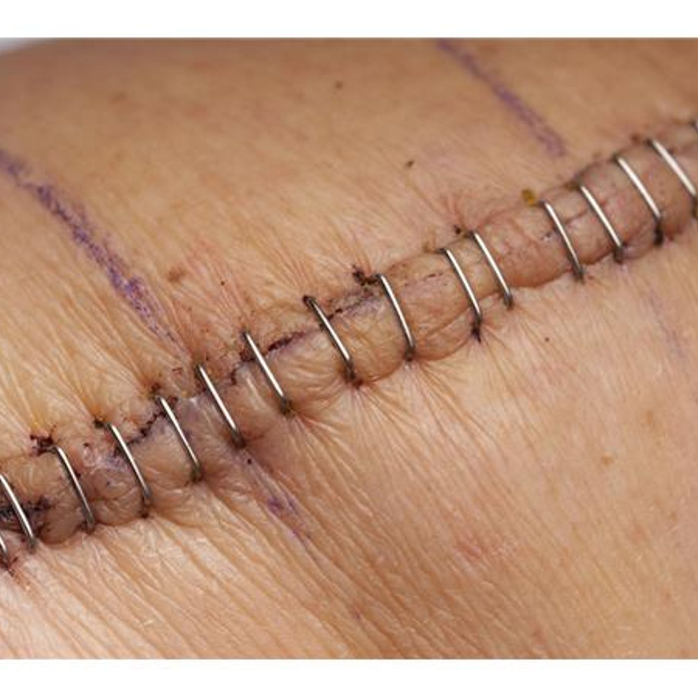 Survival Medicine Hour: Wound Closure in Survival