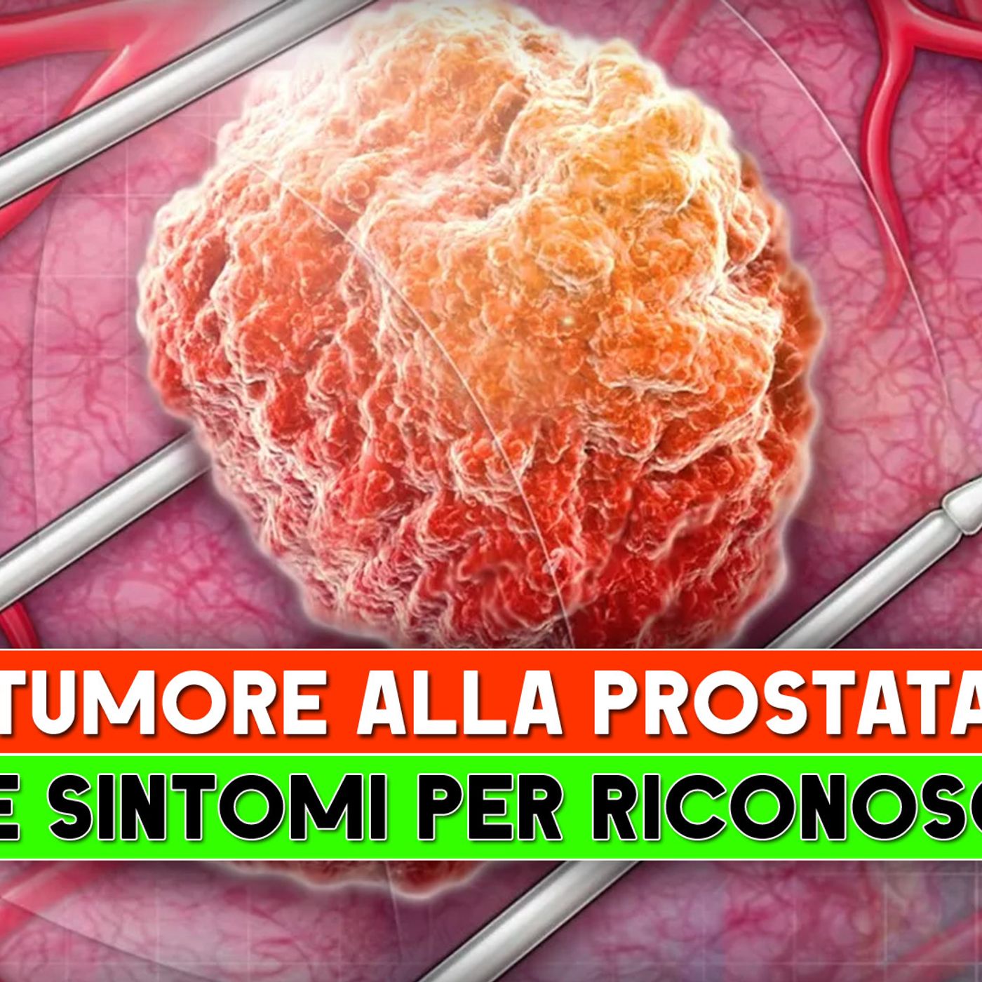 Tumore Alla Prostata: I 7 Sintomi Per Riconoscerlo! episode artwork