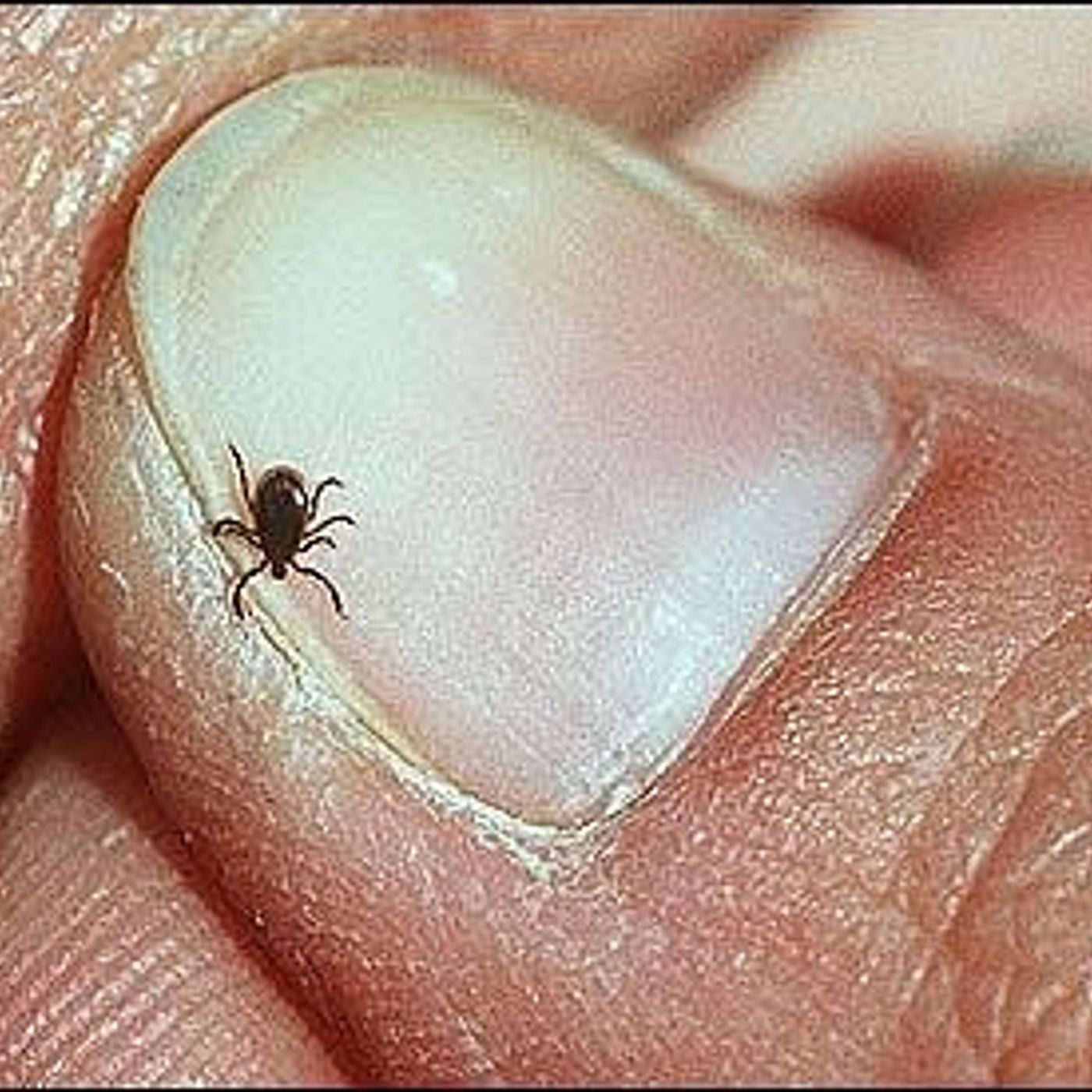 Kane County Health Department offers tick removal kits episode artwork