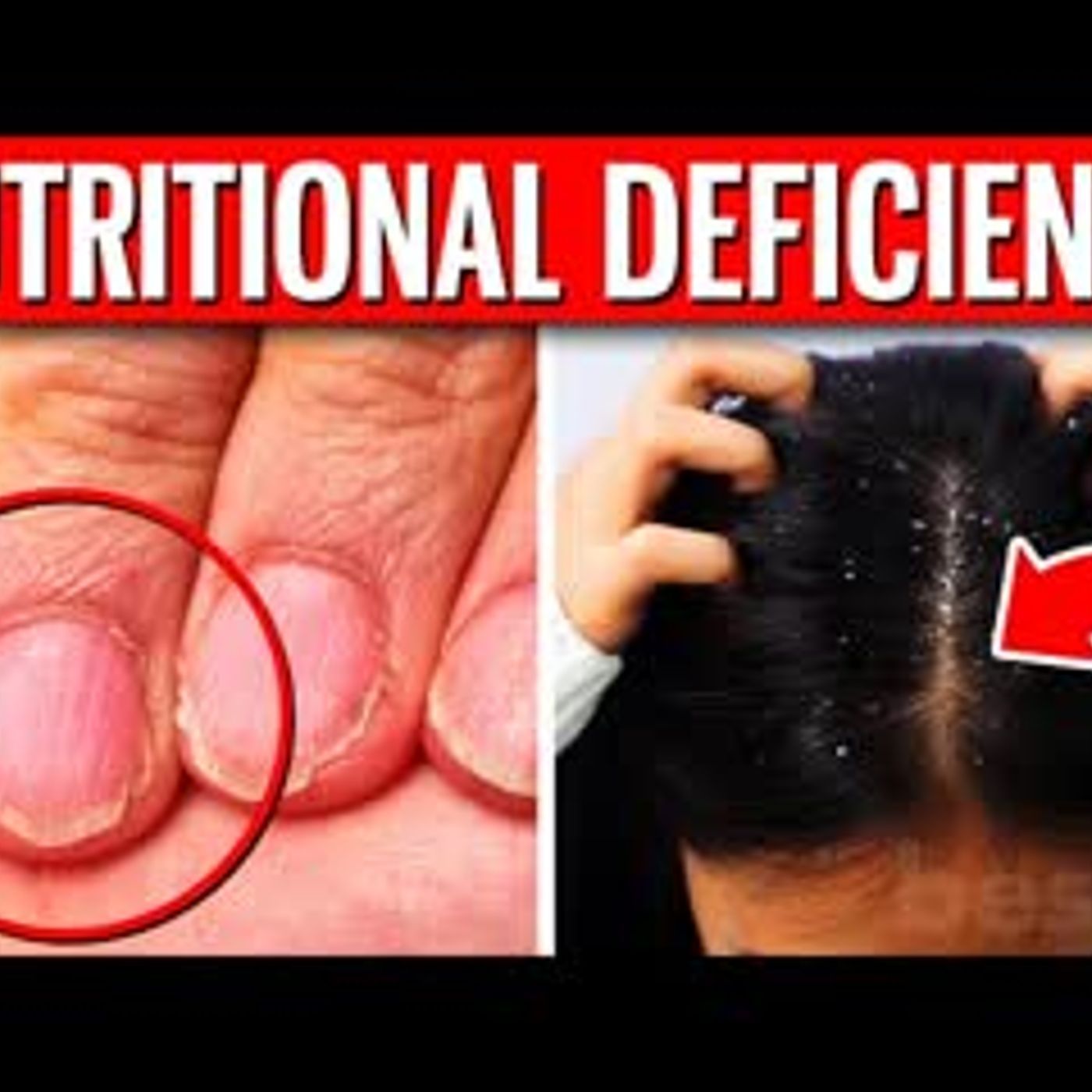 12 ALARMING Signs That Indicate You Have A Nutritional Deficiency episode artwork