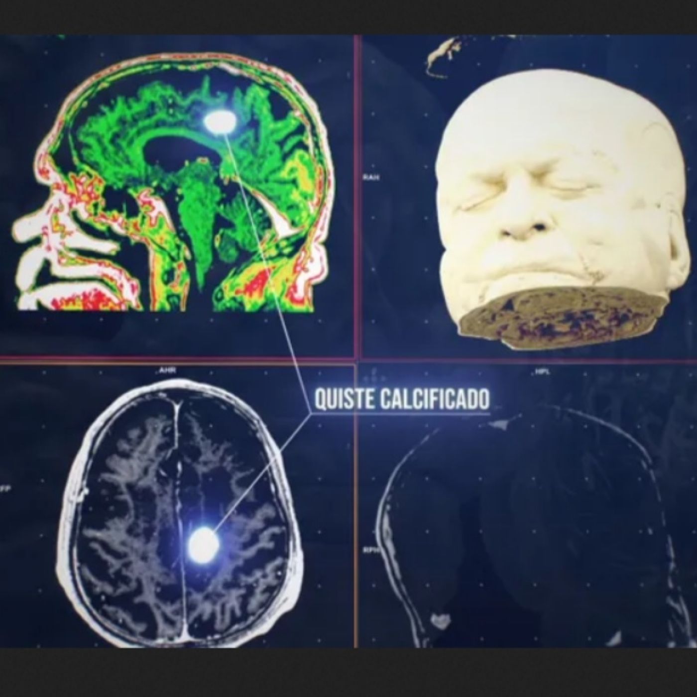 Cuarto Milenio: La plasticidad del cerebro humano