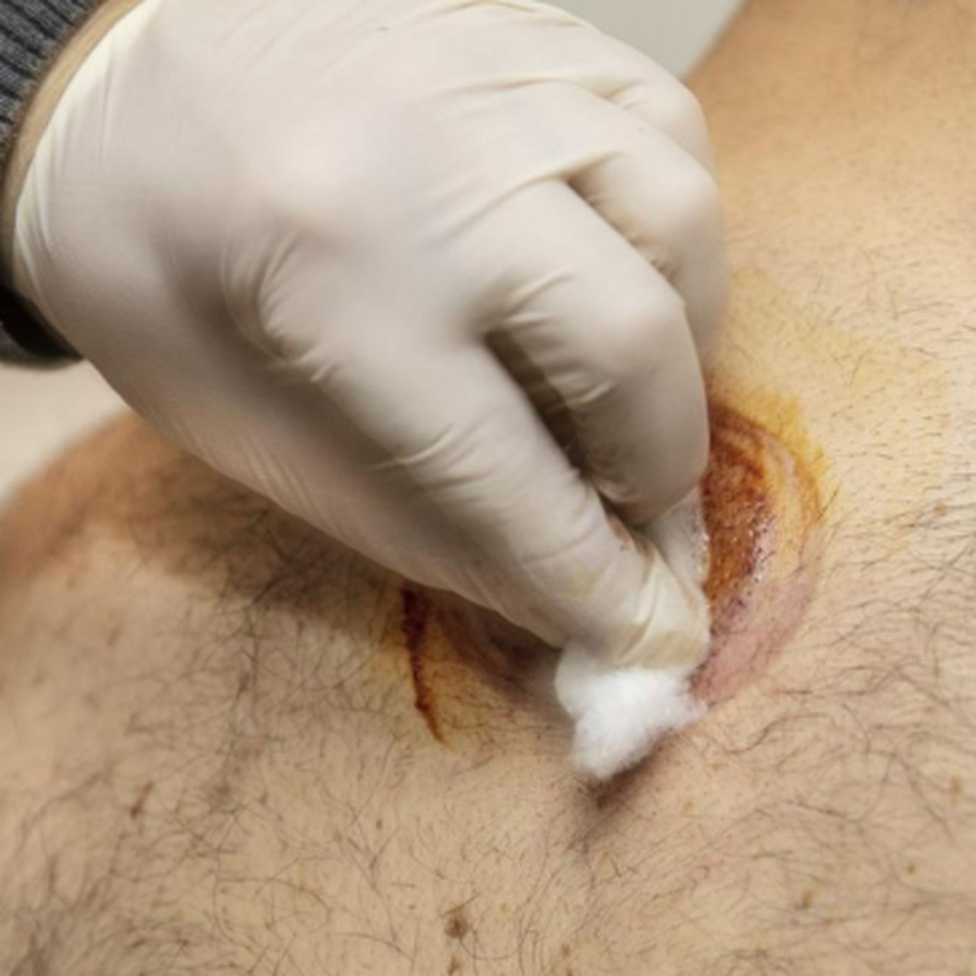 The Wound Pros Audio Blog