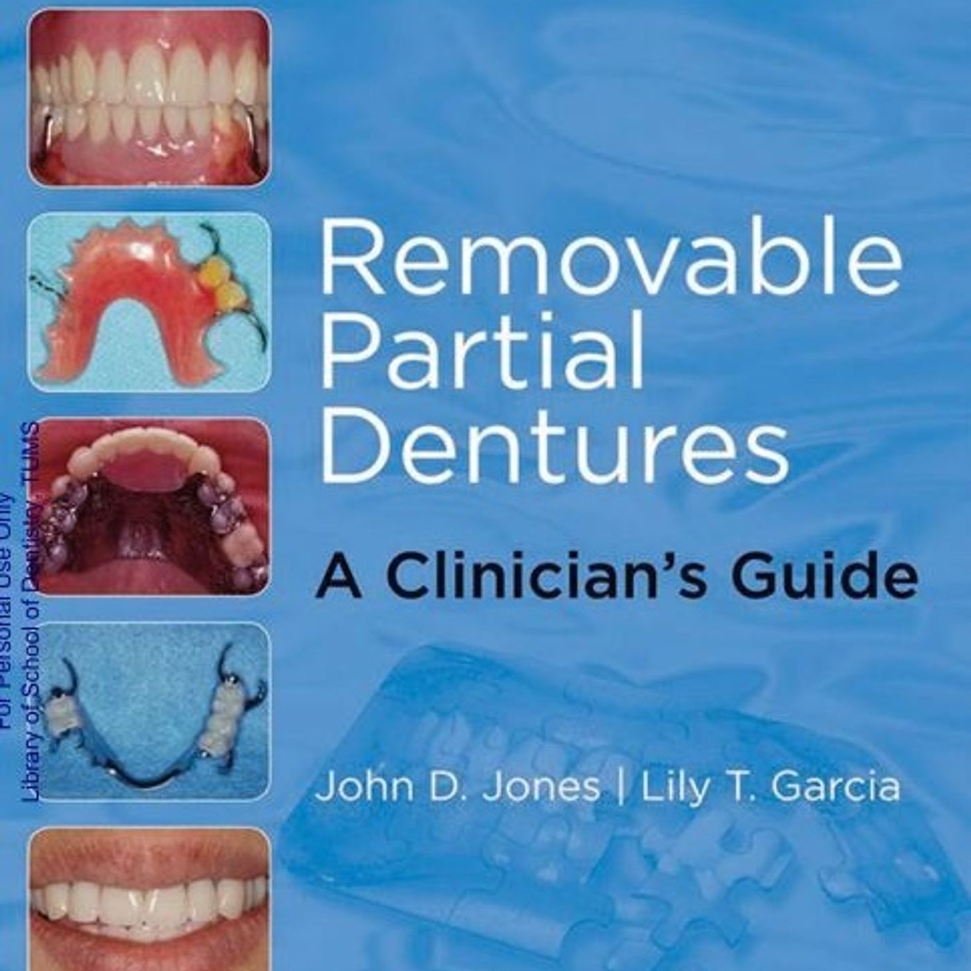 Removable Partial Dentures: A Clinician’s Guide