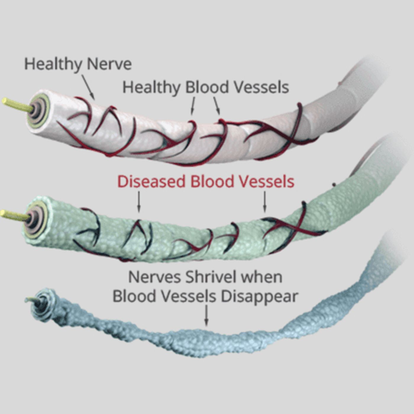 Reversing Neuropathy: A Holistic Health Assessment