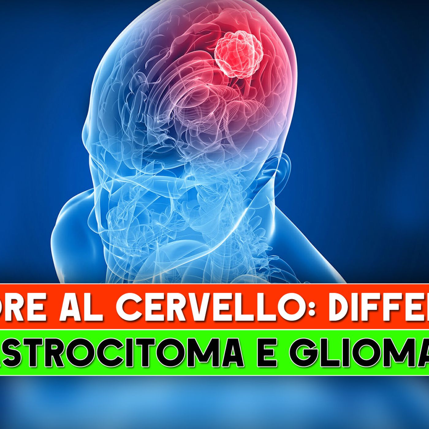 Tumore Al Cervello, Differenze: Ecco Cosa Cambia Tra Astrocitoma E Glioma! episode artwork