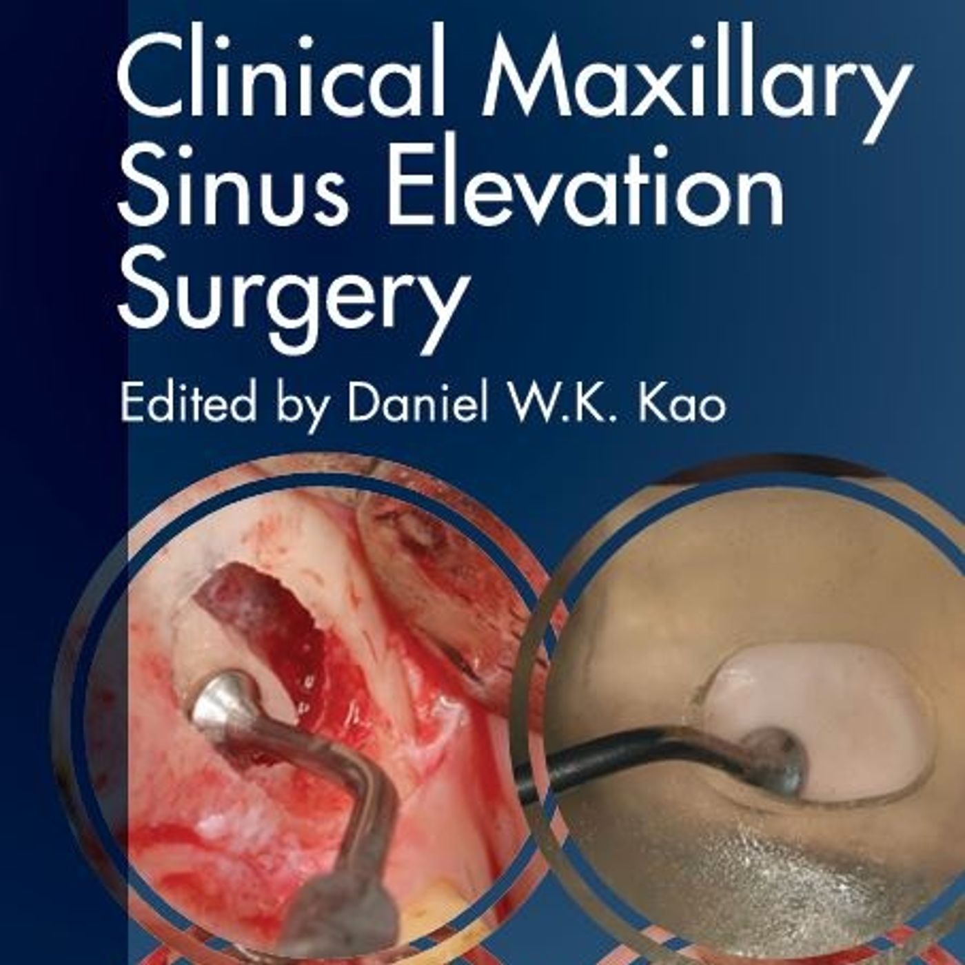Clinical Maxillary Sinus Elevation Surgery