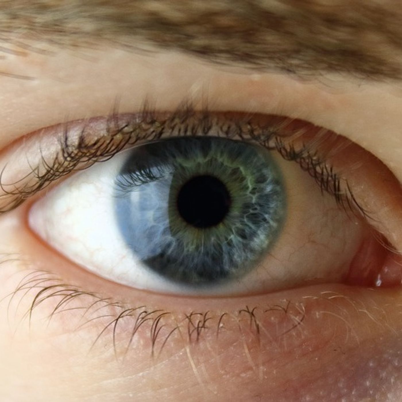 Conjuntivitis