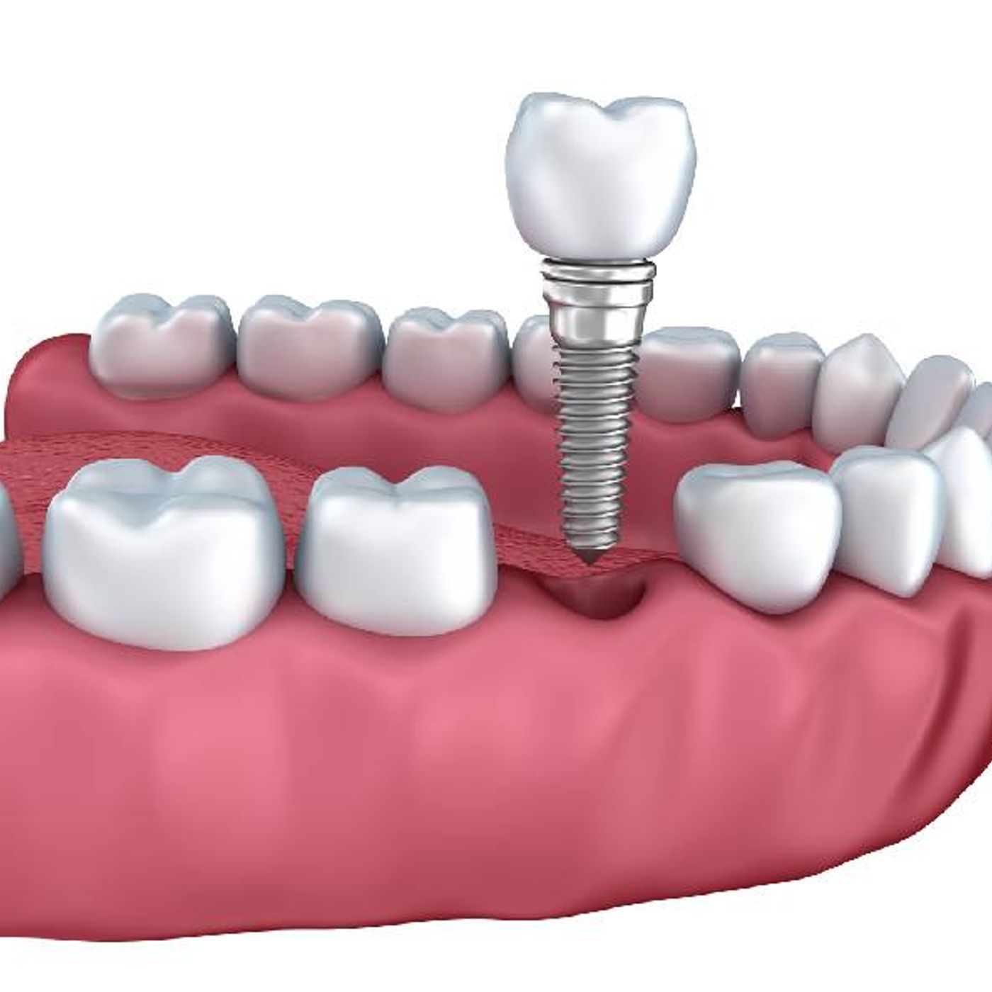 Dental Implants Types, Procedures, Benefits and More episode artwork