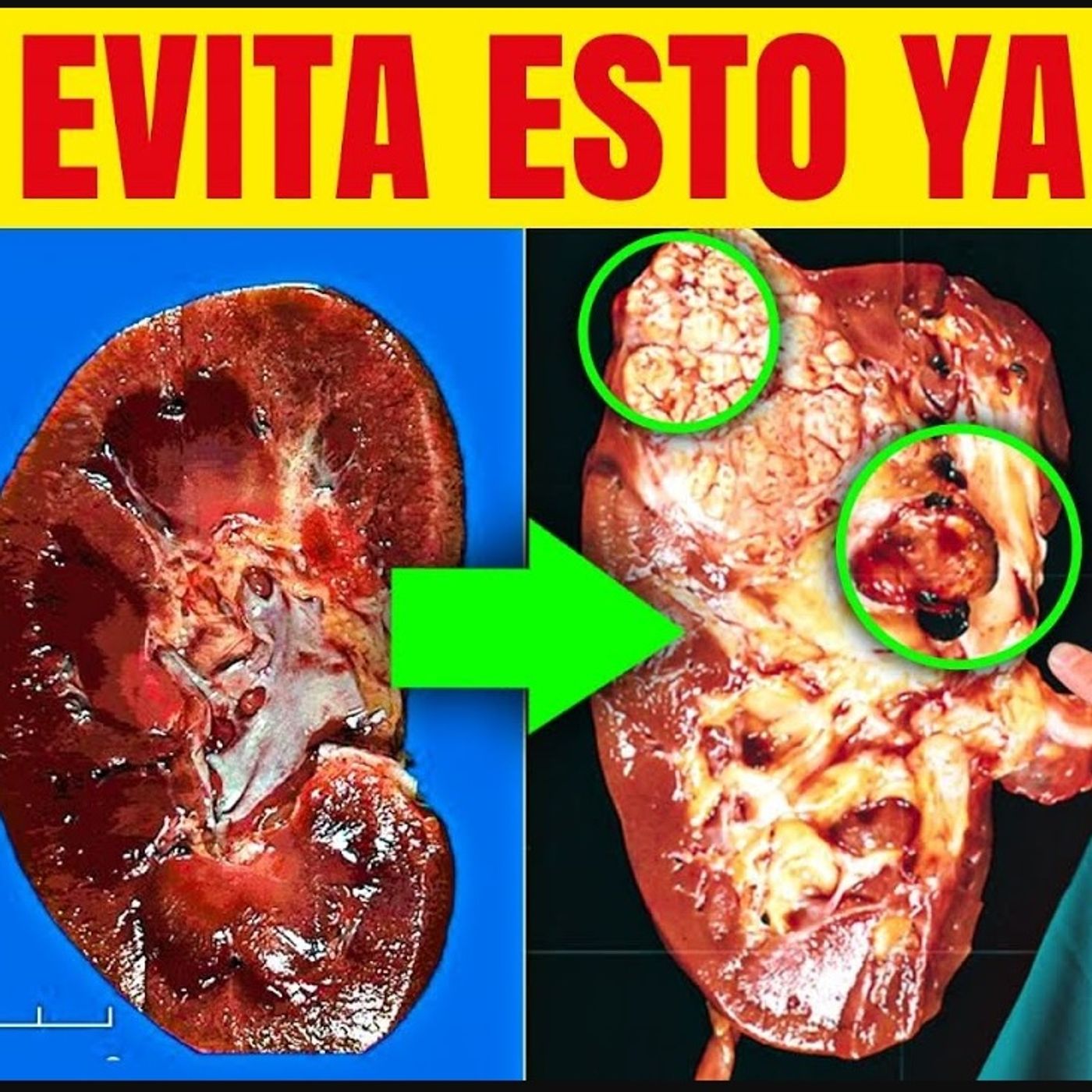 ¡AVISO RIÑONES ENFERMOS!💀❌[COME ESTO para PROTEGER tus RIÑONES]✅