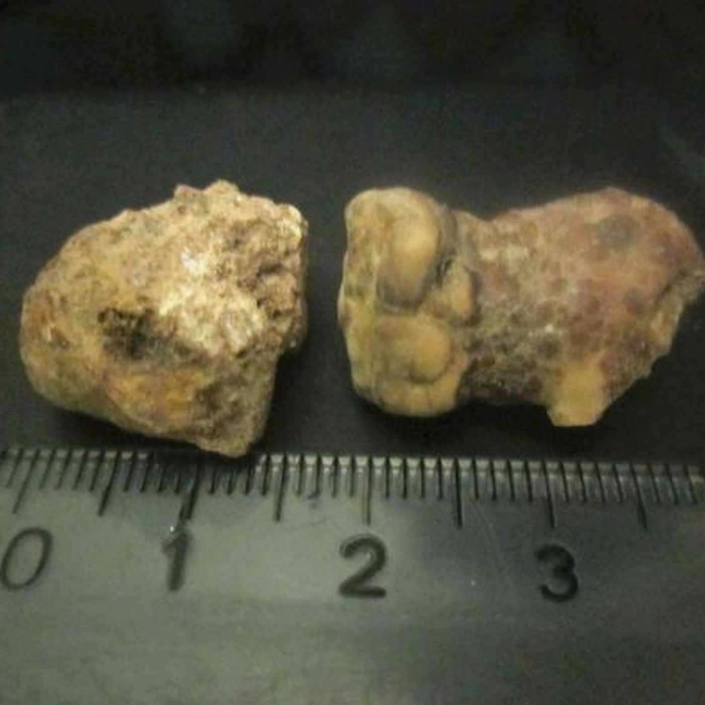 Survival Medicine Hours: Bacterial Infections, Stones, Antibiotics