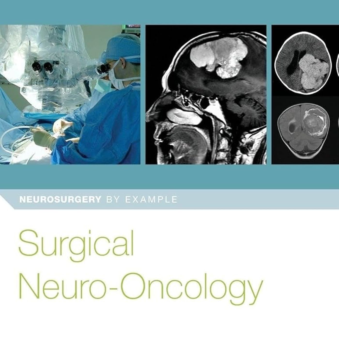 Surgical Neuro-Oncology (Neurosurgery by Example)