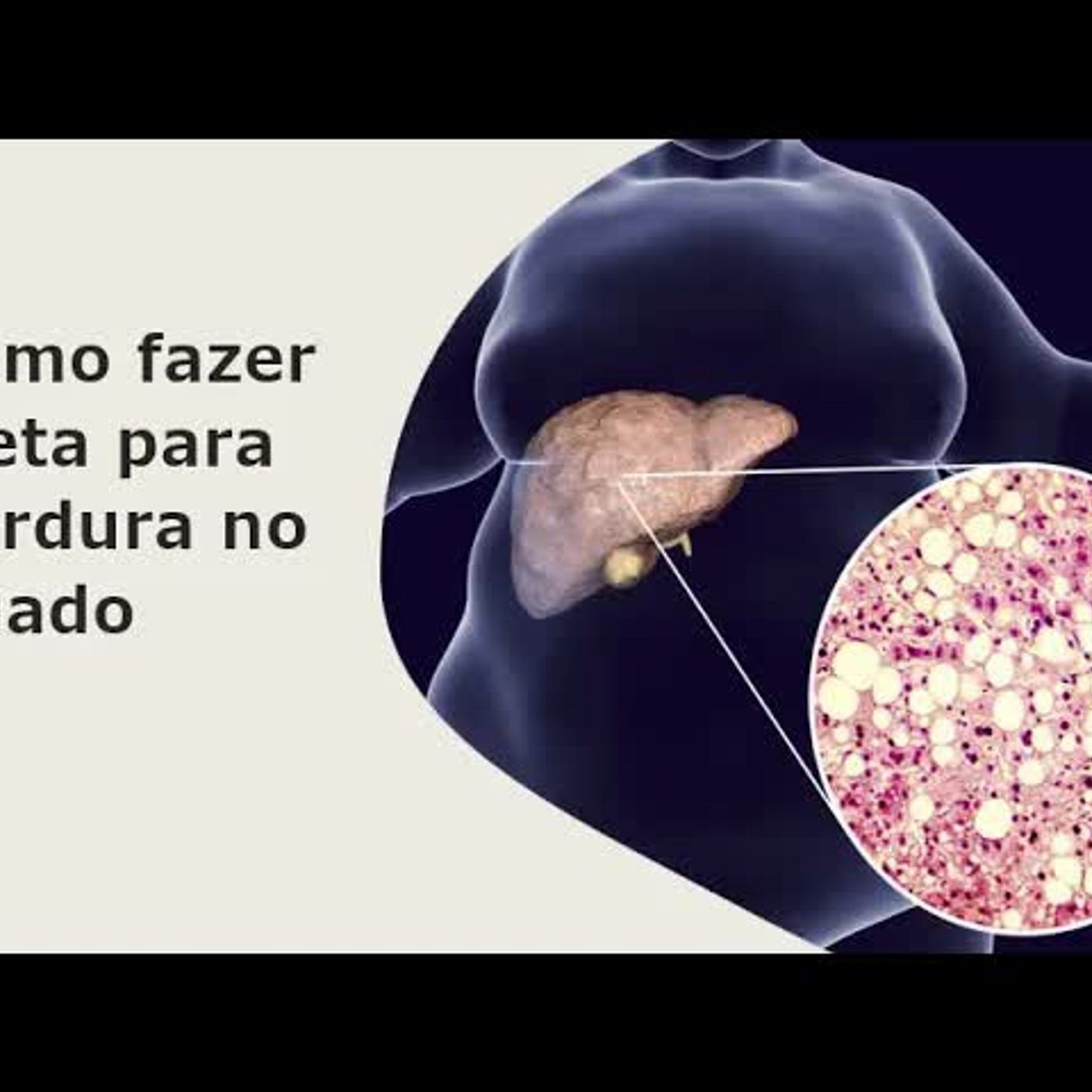 COMO FAZER DIETA PARA GORDURA NO FÍGADO
