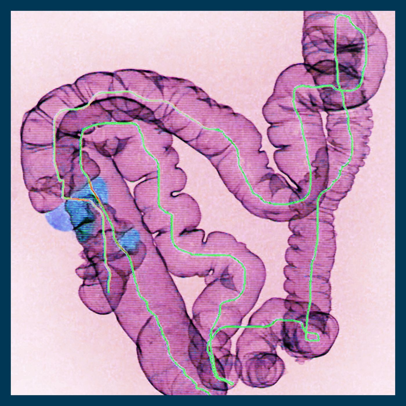 Why are more young people getting bowel cancer?