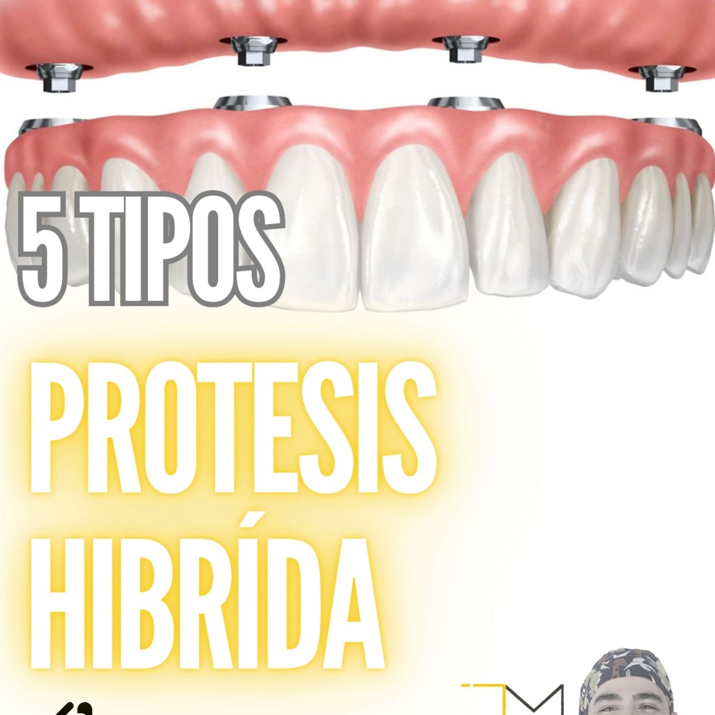 Ep. 12 Las Protesís hibridas - ¿Que tipos hay?