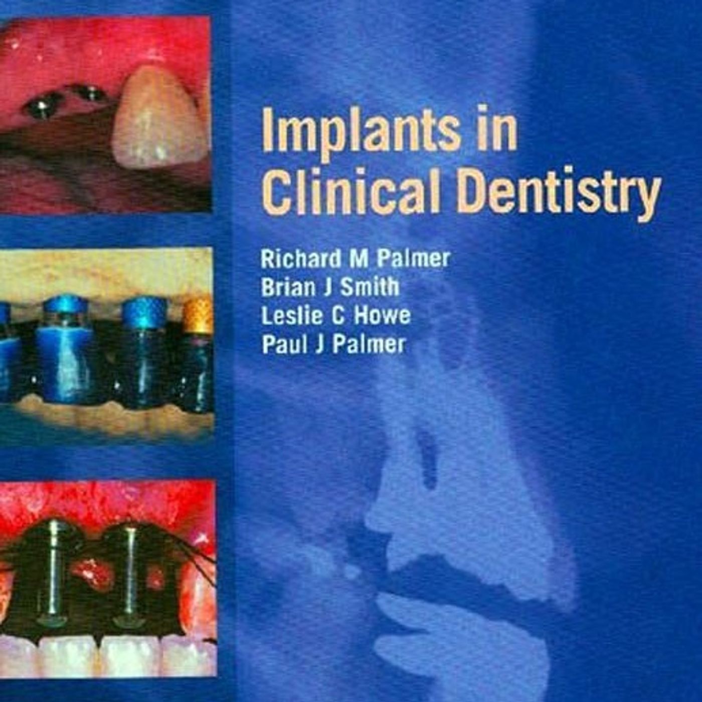 Implants in Clinical Dentistry