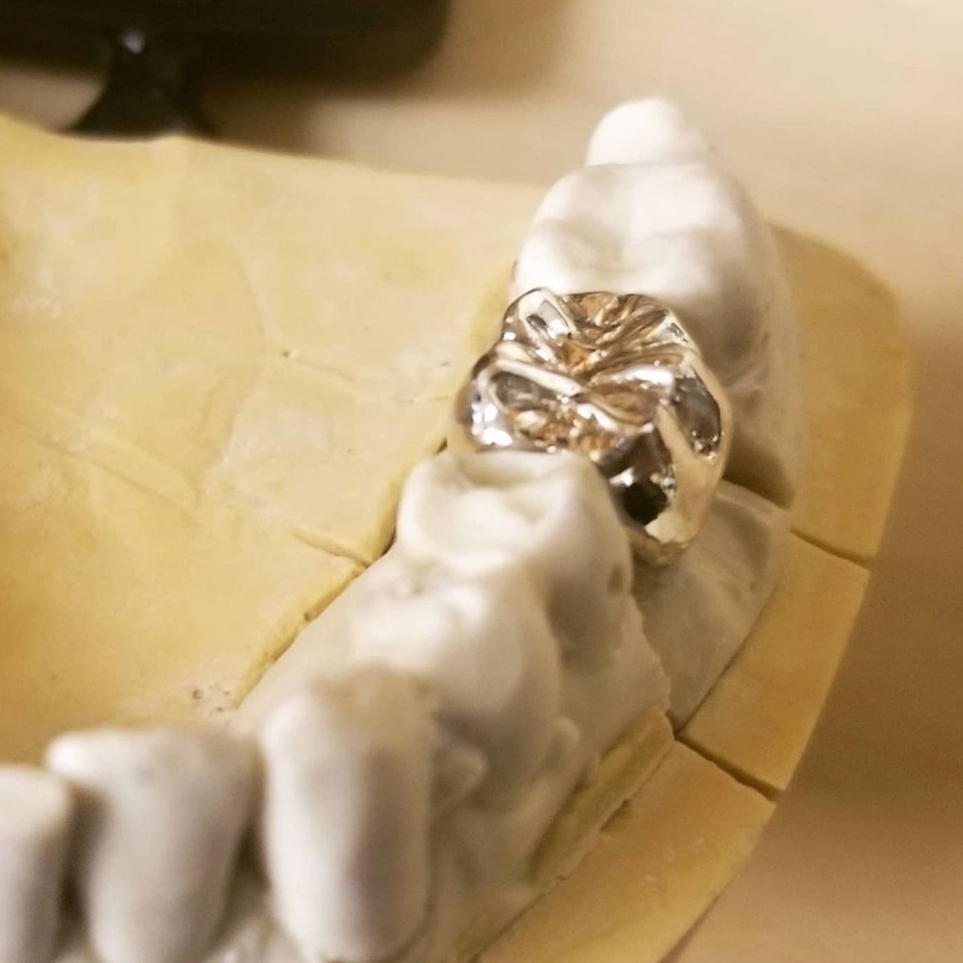 Crowns from Chairside preping to Dental Lab Fabrication