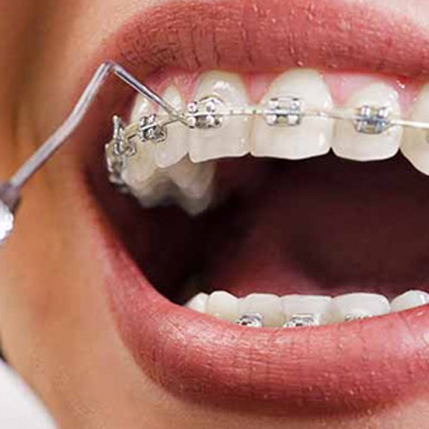 Affordable Dental Braces in Chandigarh Costs and Options episode artwork