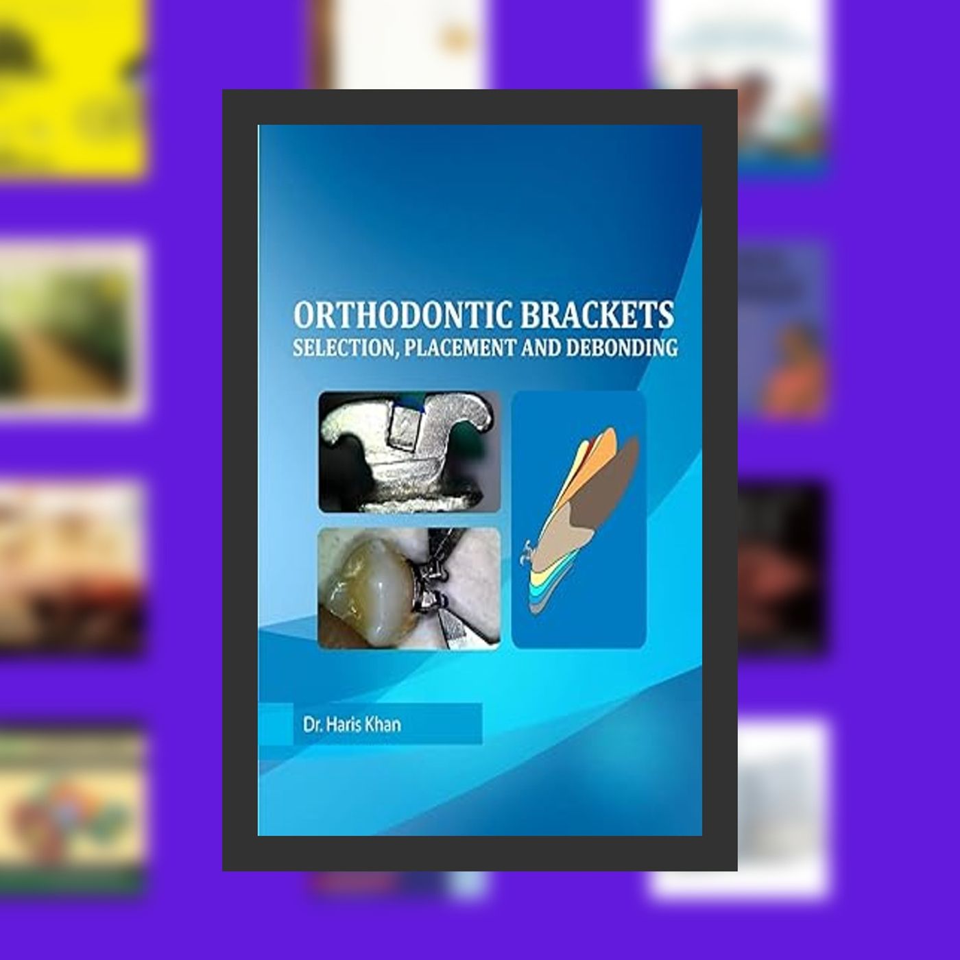 PDF [Download] Orthodontic Brackets: Selection,Placement and Debonding By  Dr Haris Khan (Author)  Full Episode episode artwork