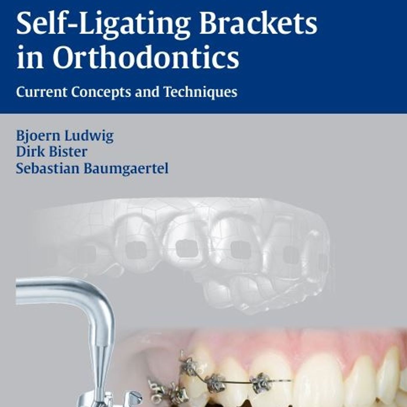 Self-Ligating Brackets in Orthodontics