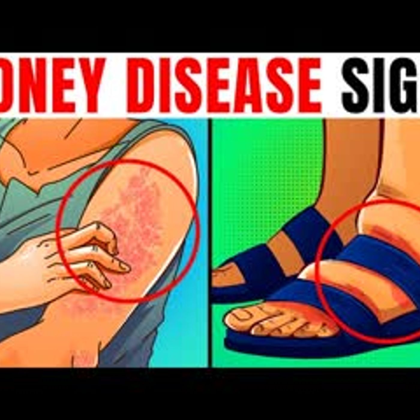 10 Kidney Disease WARNING Signs You Must NOT IGNORE! episode artwork